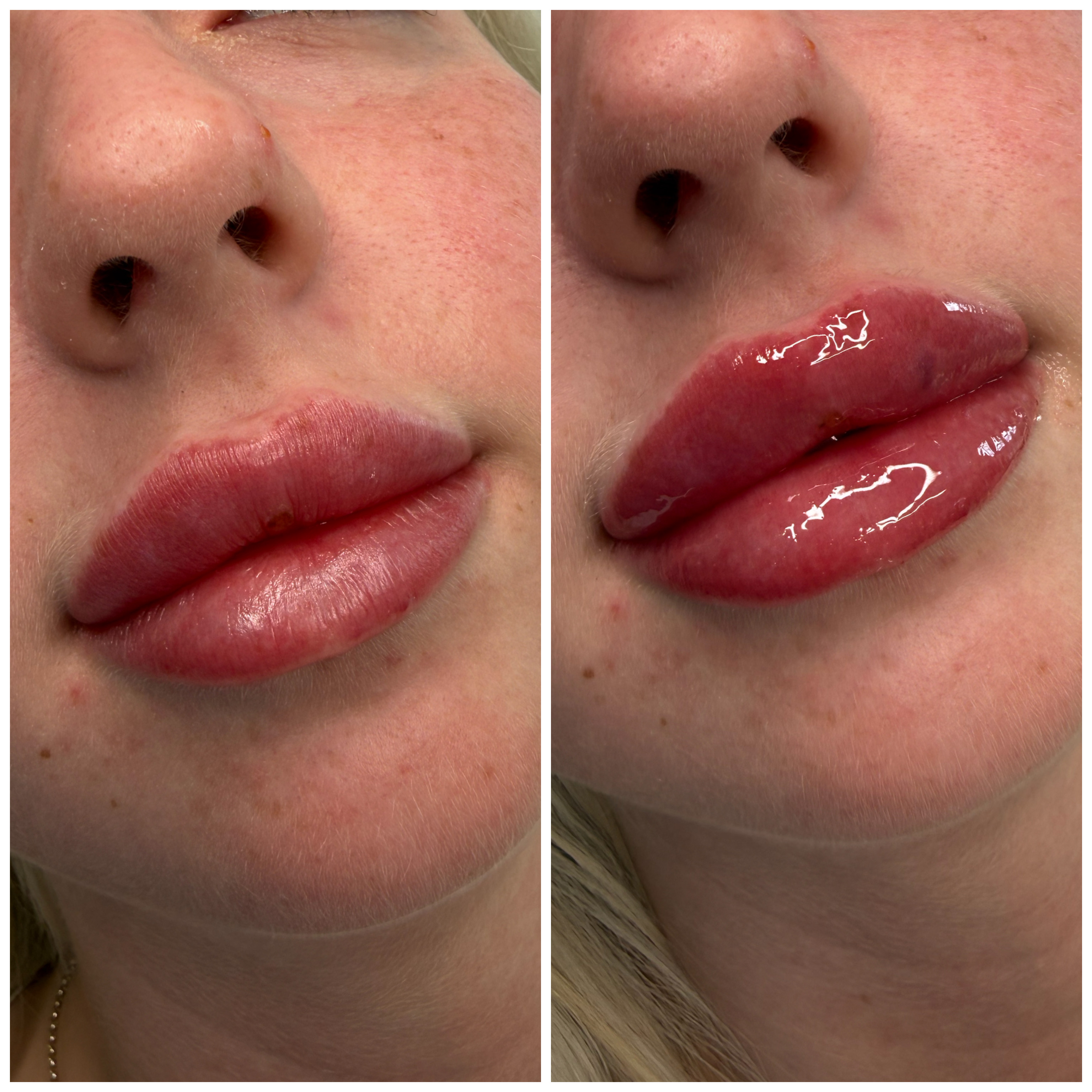 Lip Filler (Augmentation) — before and after results — at Mac Aesthetics — Newtownabbey