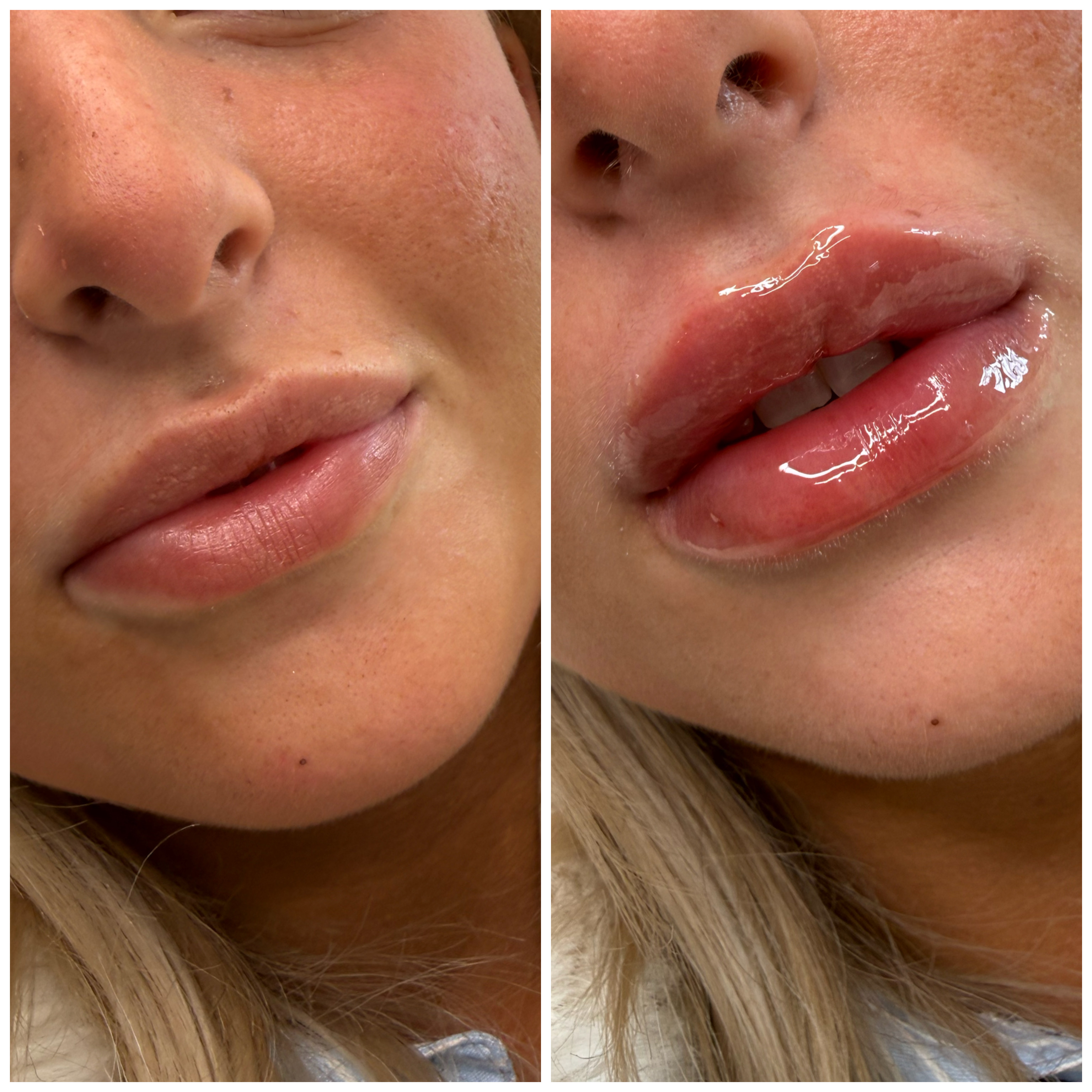 Lip Filler (Augmentation) — before and after results — at Mac Aesthetics — Newtownabbey