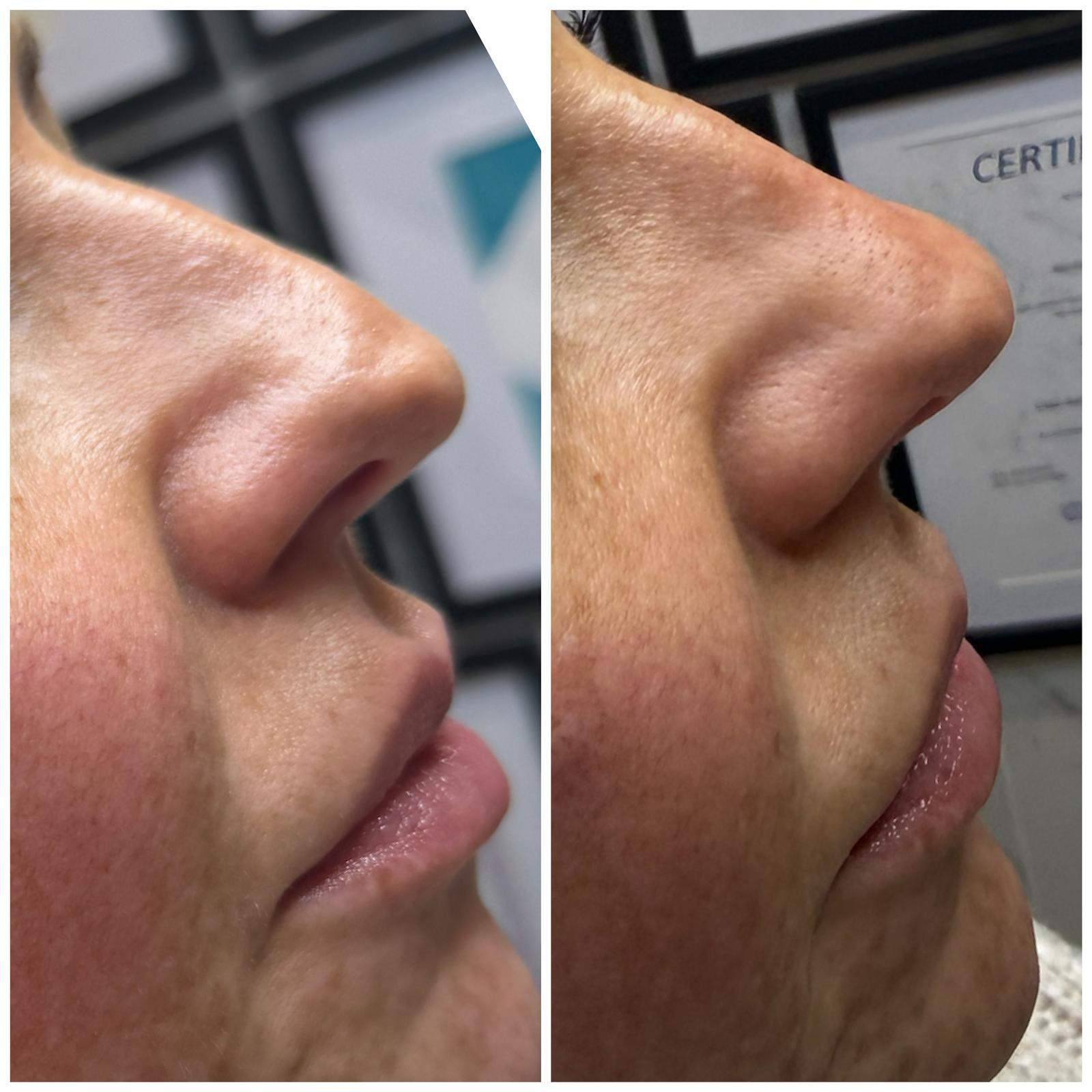 Nose Reshaping (Non-Surgical Rhinoplasty) — before and after results — at Mac Aesthetics — Newtownabbey