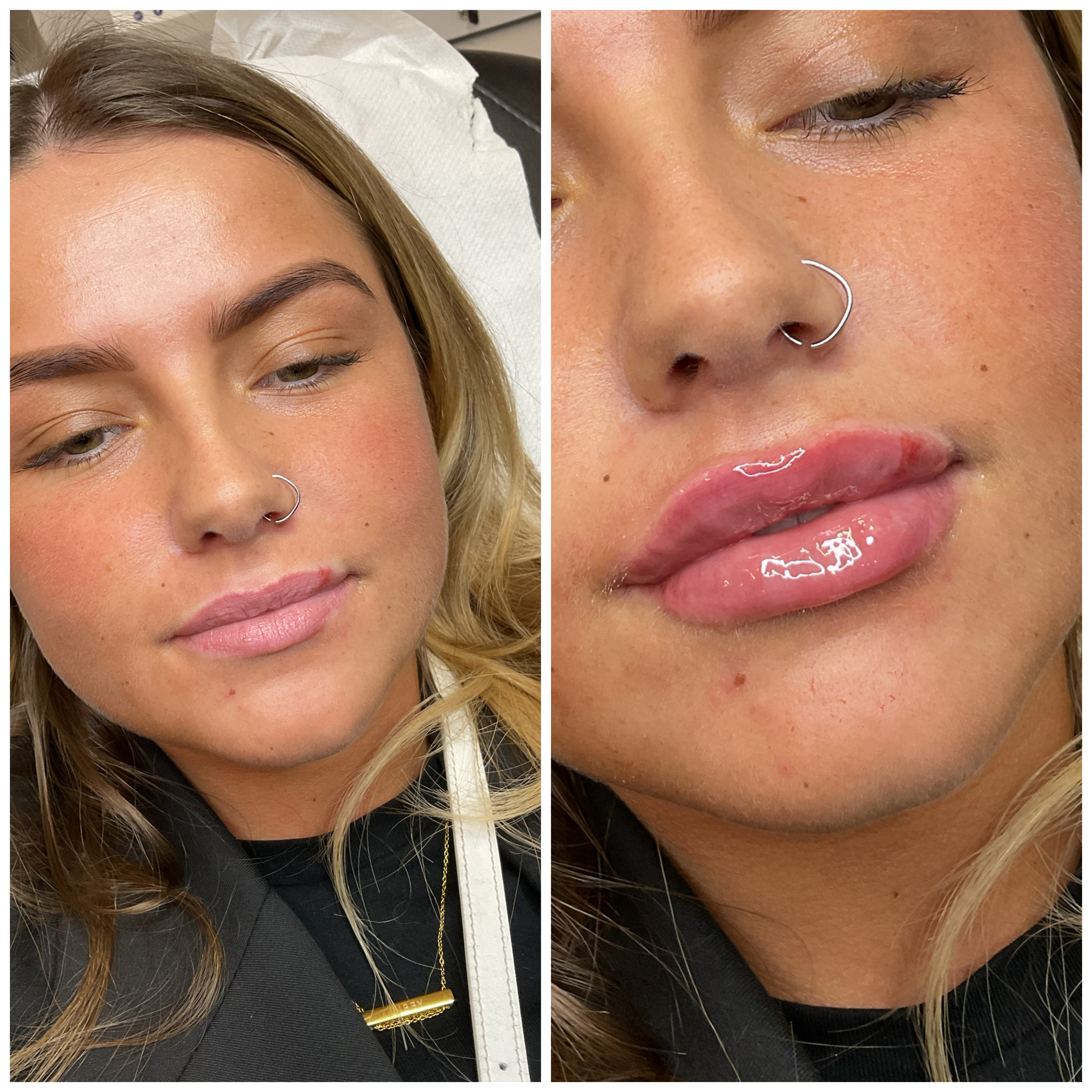 Lip Filler (Augmentation) — before and after results — at Mac Aesthetics — Newtownabbey
