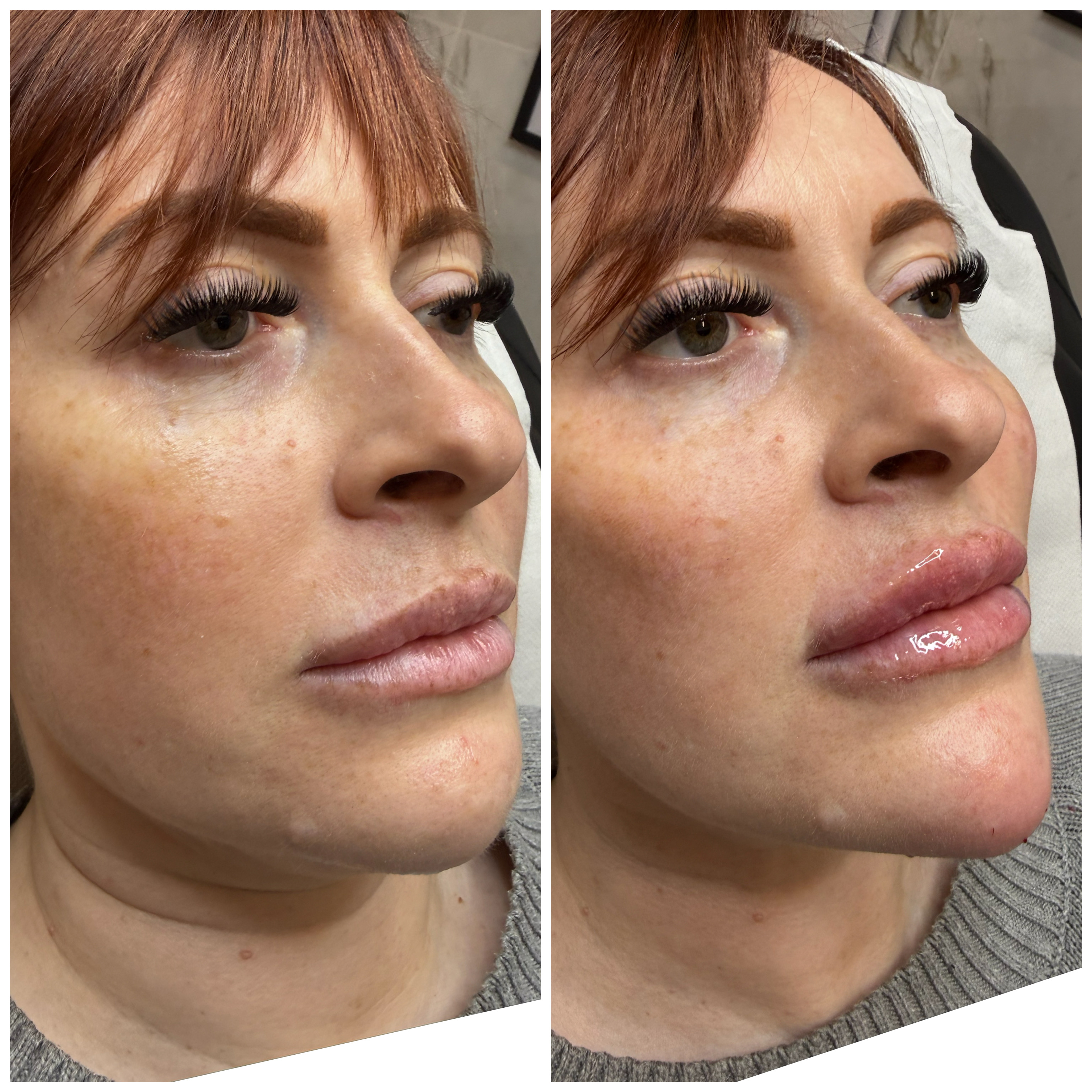 Face Lift (Injectables) — treatment results — at Mac Aesthetics — Newtownabbey