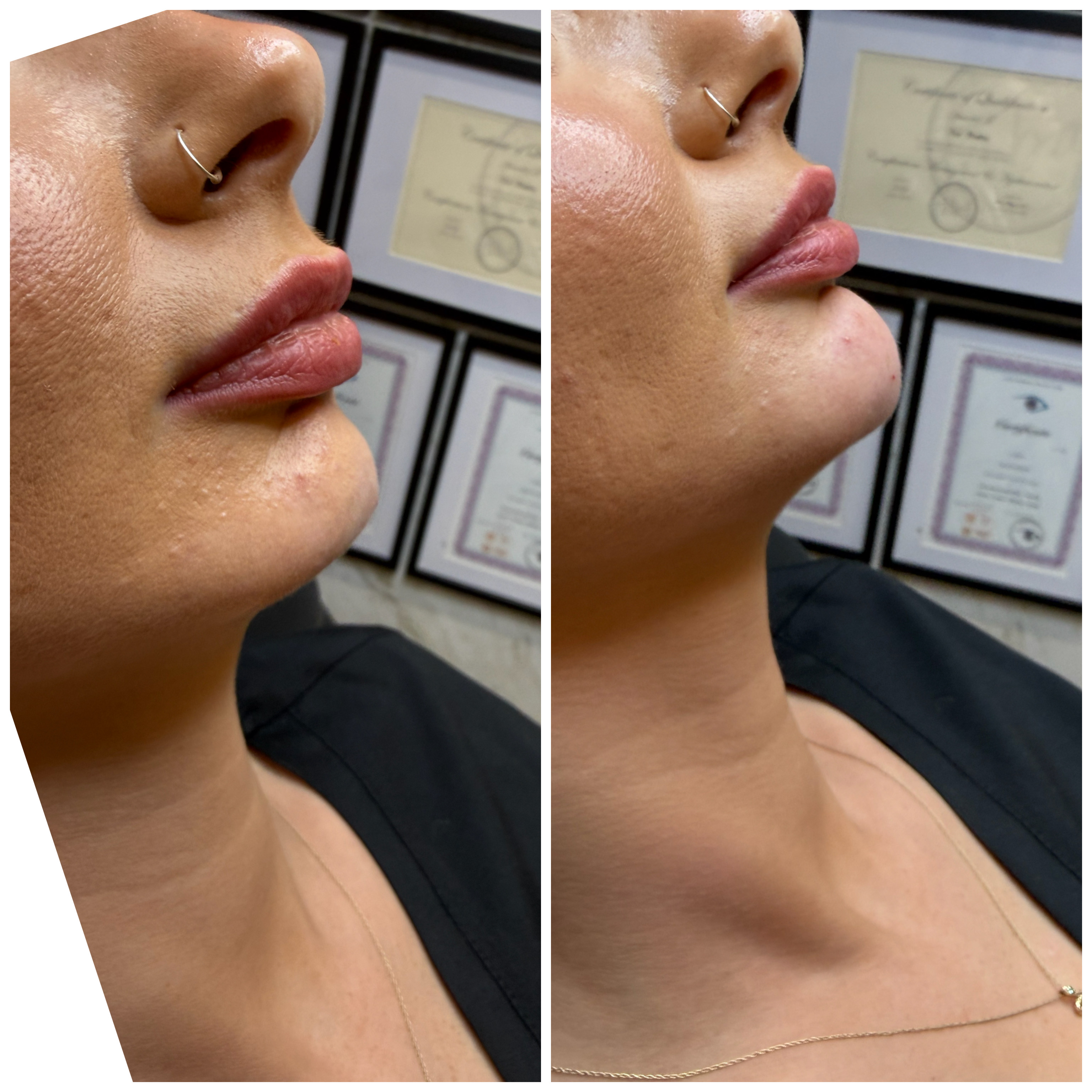 Chin Filler — treatment results — at Mac Aesthetics — Newtownabbey