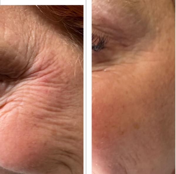 Anti Wrinkle Injections — treatment results — at Mac Aesthetics — Newtownabbey