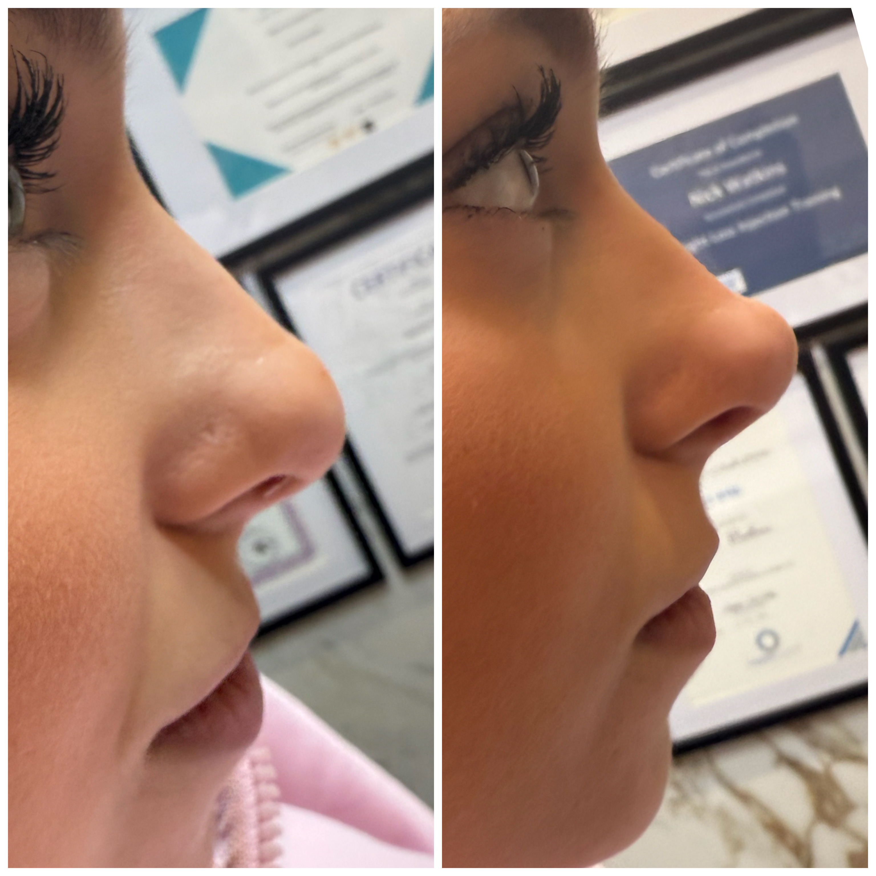 Nose Reshaping (Non-Surgical Rhinoplasty) — treatment results — at Mac Aesthetics — Newtownabbey