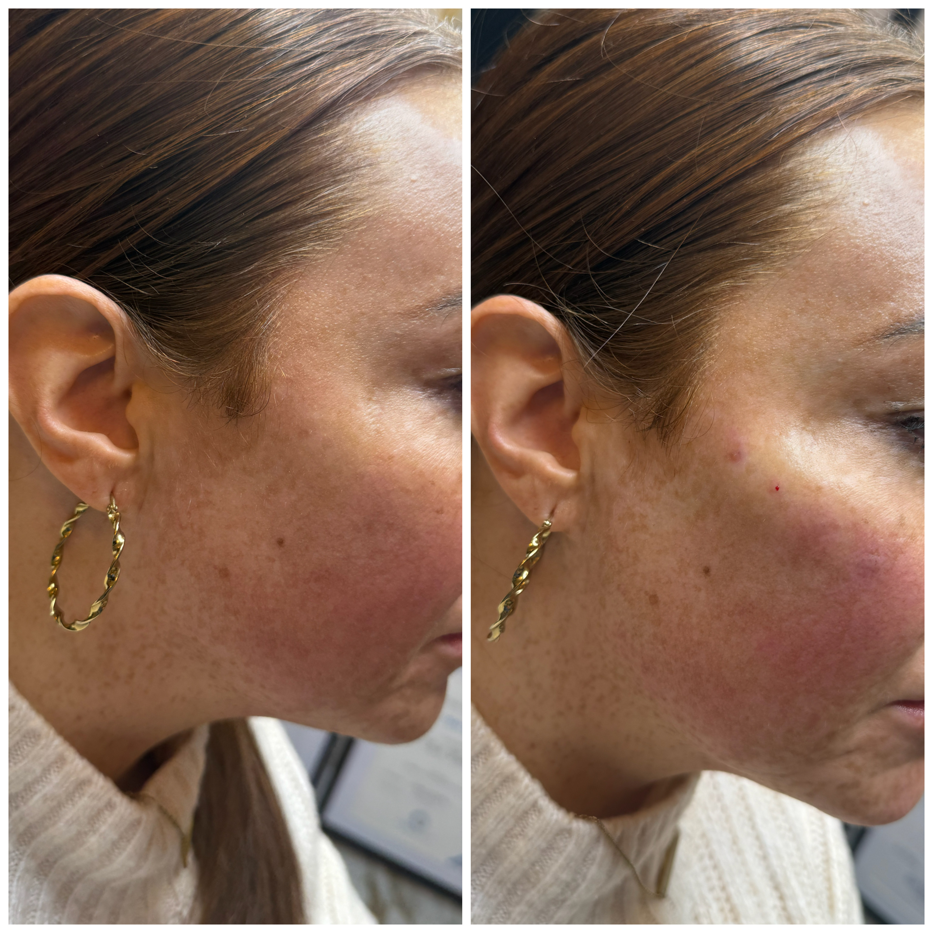 Cheek Fillers — before and after results — at Mac Aesthetics — Newtownabbey