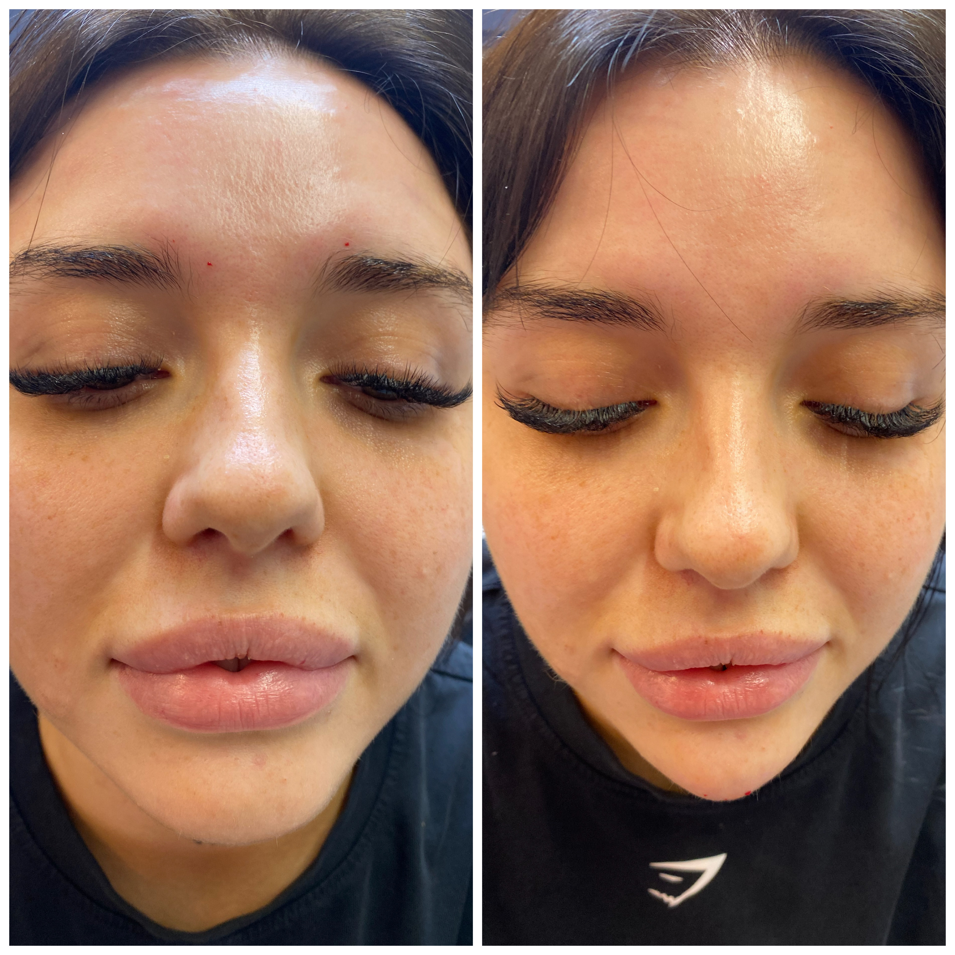 Face Lift (Injectables) — before and after results — at Mac Aesthetics — Newtownabbey