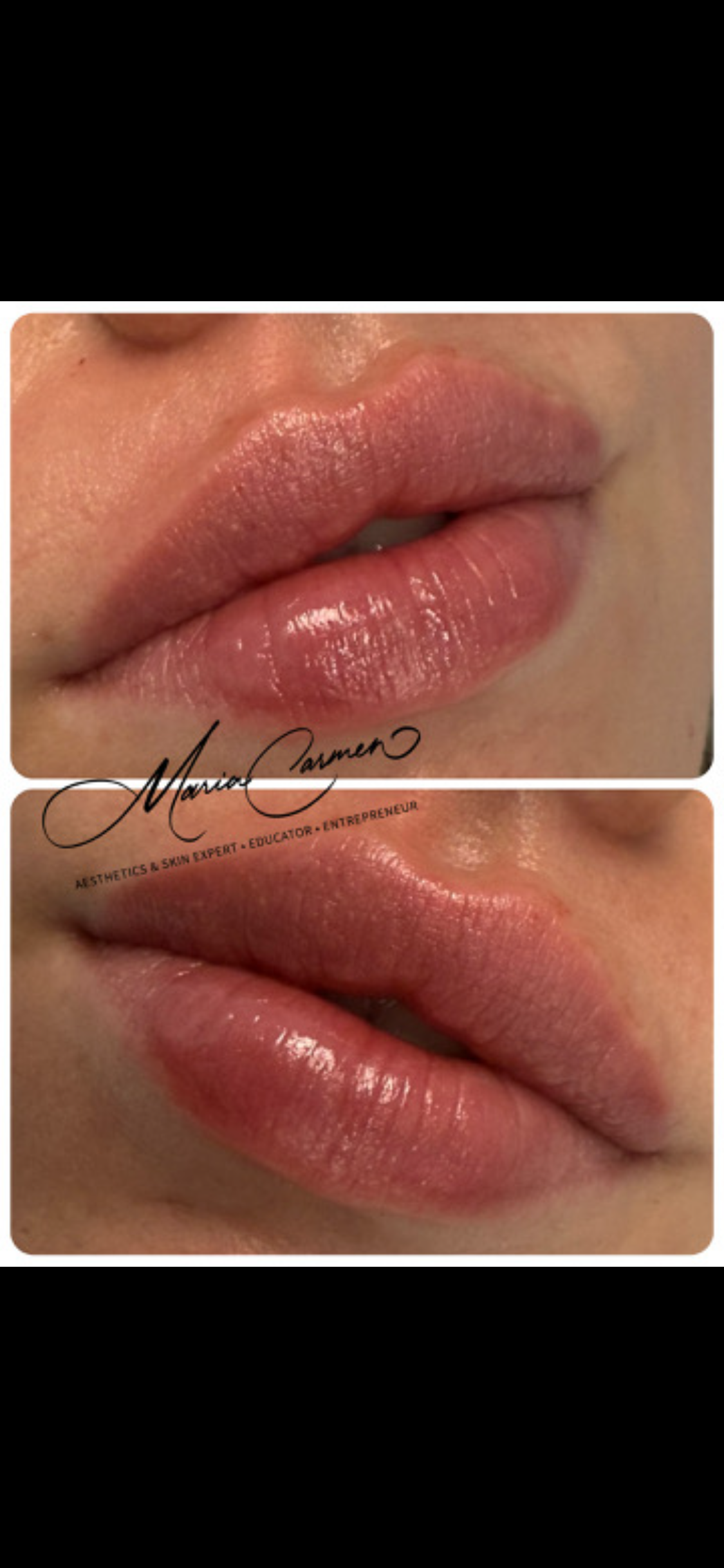 Lip Filler (Augmentation) — treatment results — at Maria Mann Aesthetics — Uckfield
