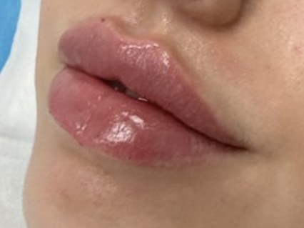 Lip Filler (Augmentation) — treatment results — at Maria Mann Aesthetics — Uckfield