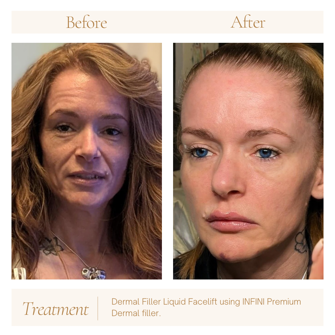 Face Lift (Injectables) — treatment results — at Maria Mann Aesthetics — Uckfield