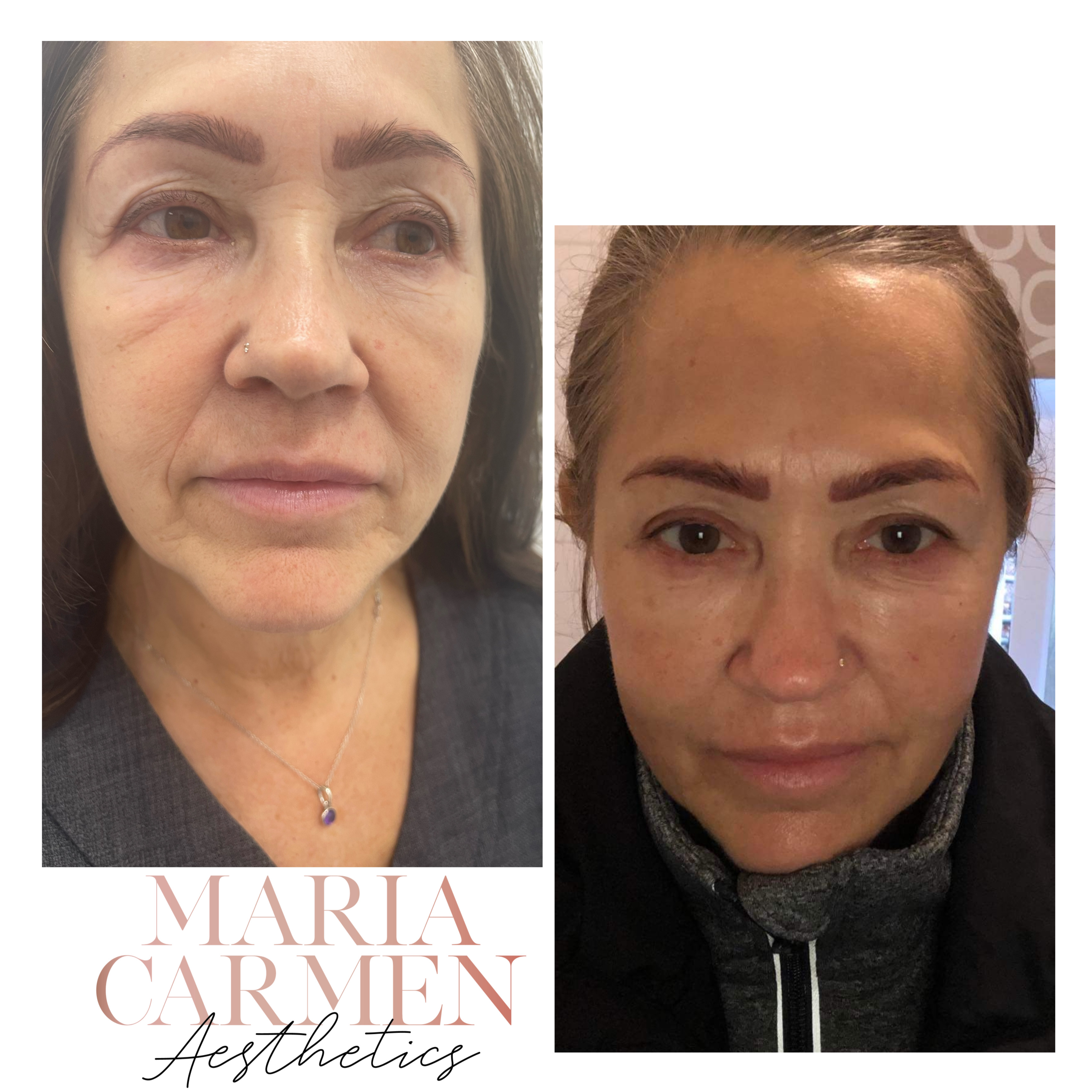 Thread Lifts (Non-Surgical) — treatment results — at Maria Mann Aesthetics — Uckfield