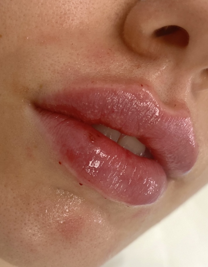 Lip Filler (Augmentation) — treatment results — at Maria Mann Aesthetics — Uckfield