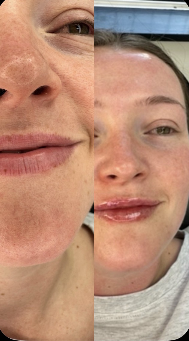 Lip Filler (Augmentation) — before and after results — at Elite Precision Aesthetics — Halesowen
