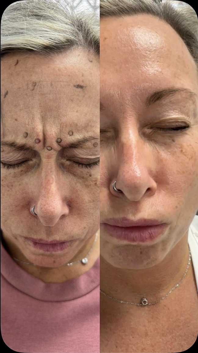 Anti Wrinkle Injections — before and after results — at Elite Precision Aesthetics — Halesowen