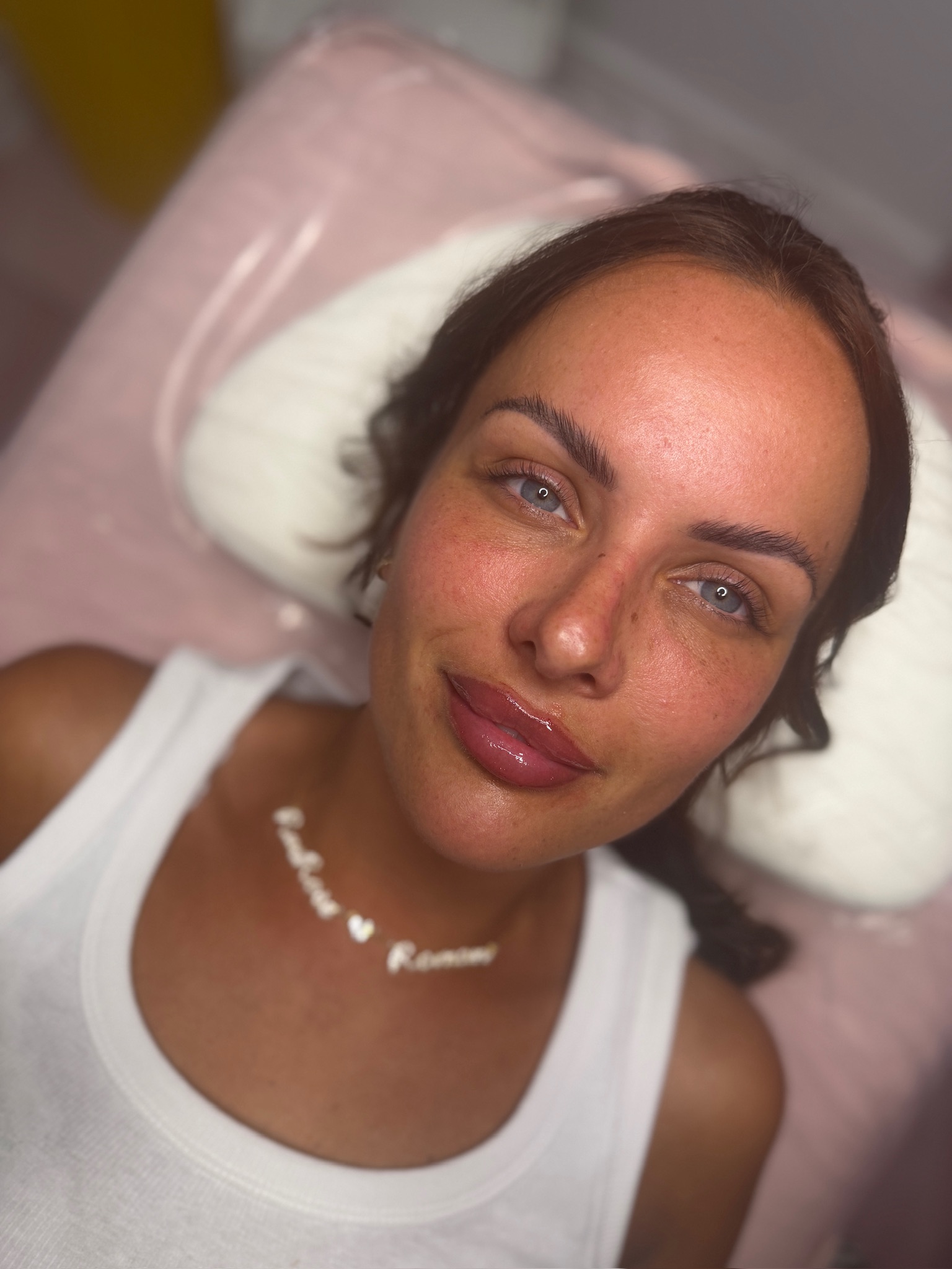 Lip Filler (Augmentation) — treatment results — at ATB Aesthetics | Lip Fillers - Anti Wrinkle Treatments — Maldon