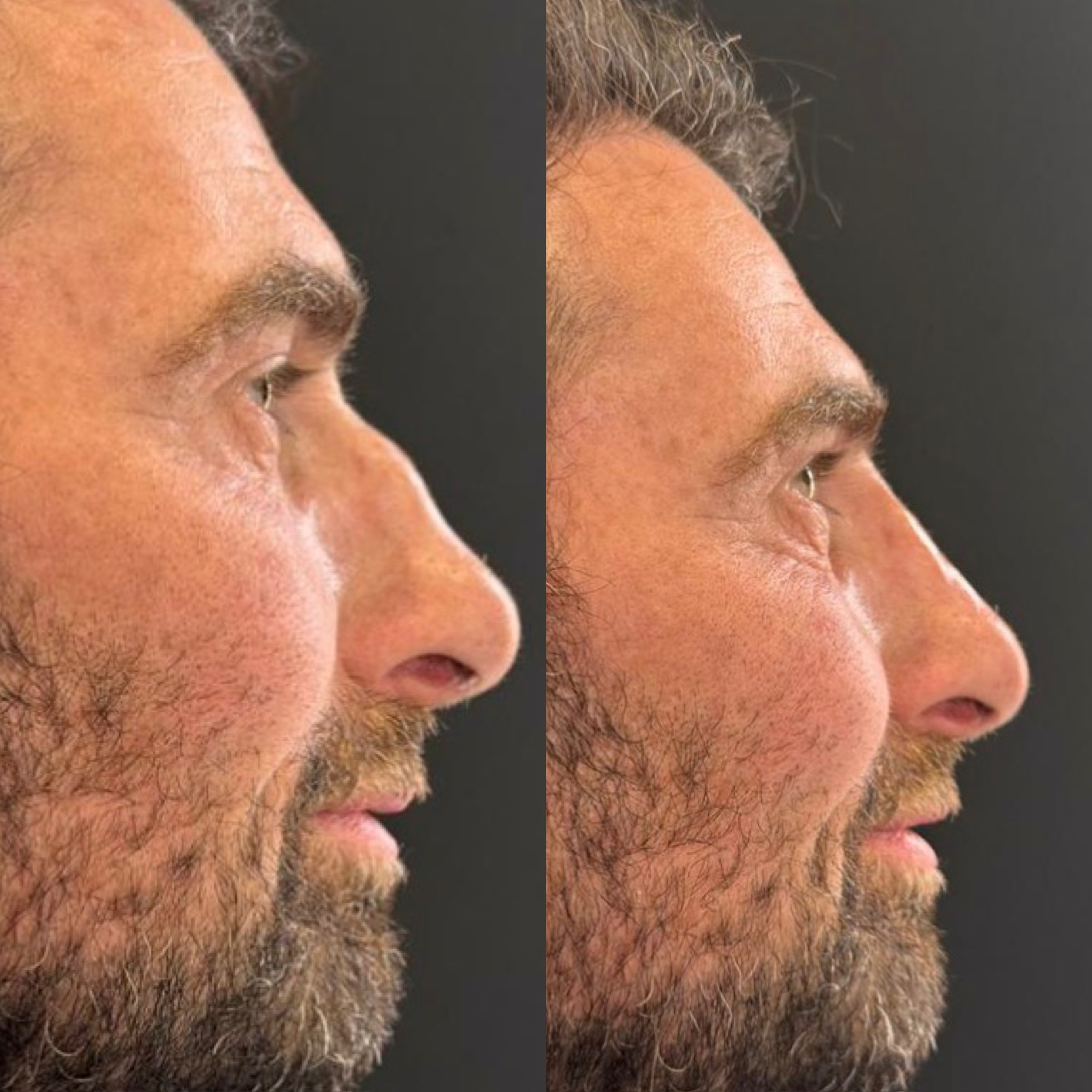 Nose Reshaping (Rhinoplasty) (Surgical) — before and after results — at ATB Aesthetics | Lip Fillers - Anti Wrinkle Treatments — Maldon