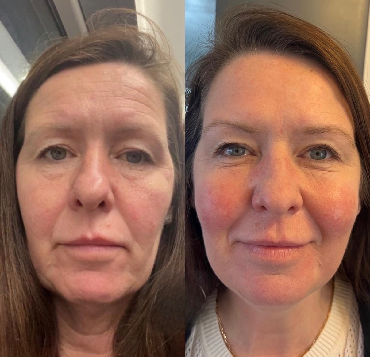 Skin Boosters — before and after results — at ATB Aesthetics | Lip Fillers - Anti Wrinkle Treatments — Maldon