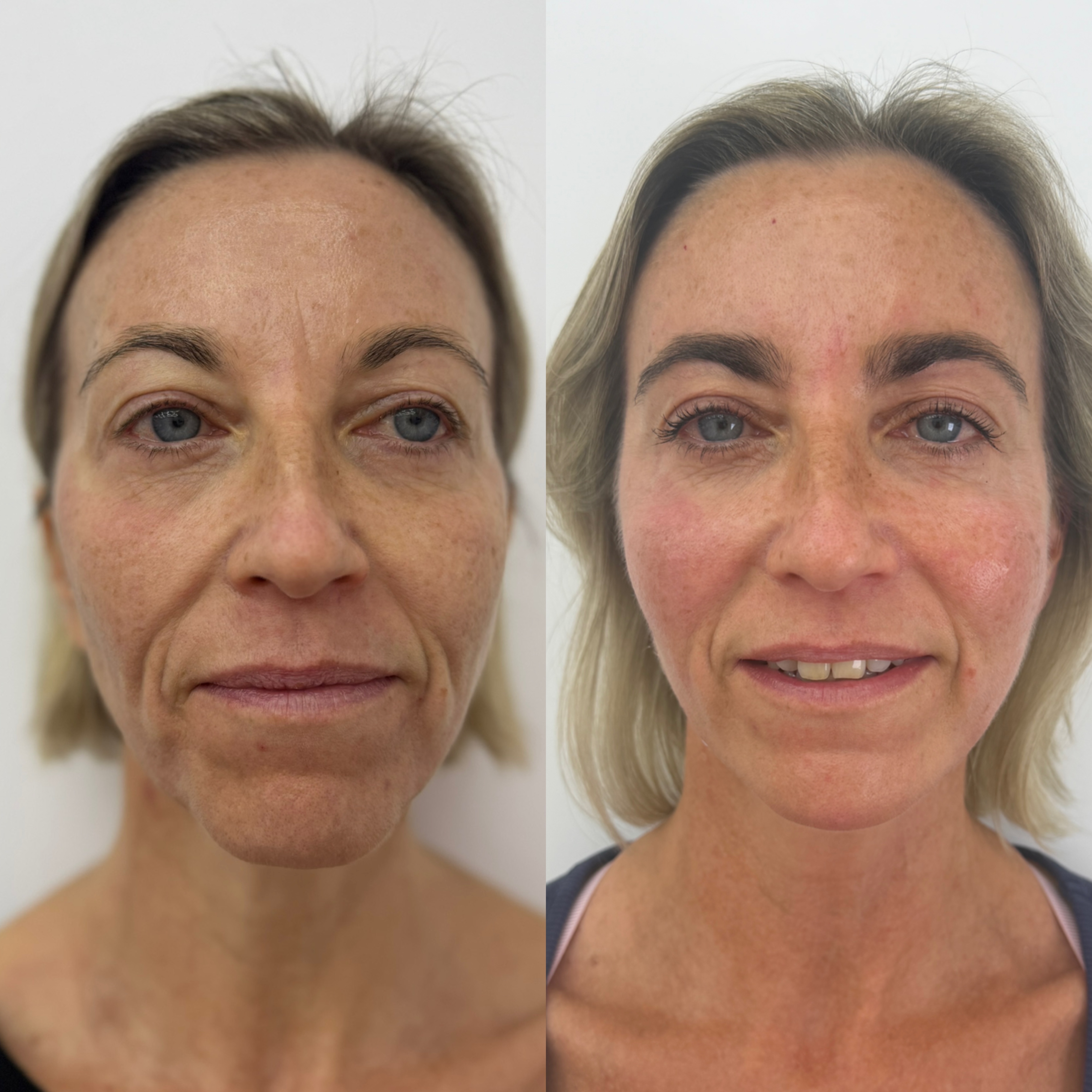 Dermal Filler Injections — before and after results — at ATB Aesthetics | Lip Fillers - Anti Wrinkle Treatments — Maldon