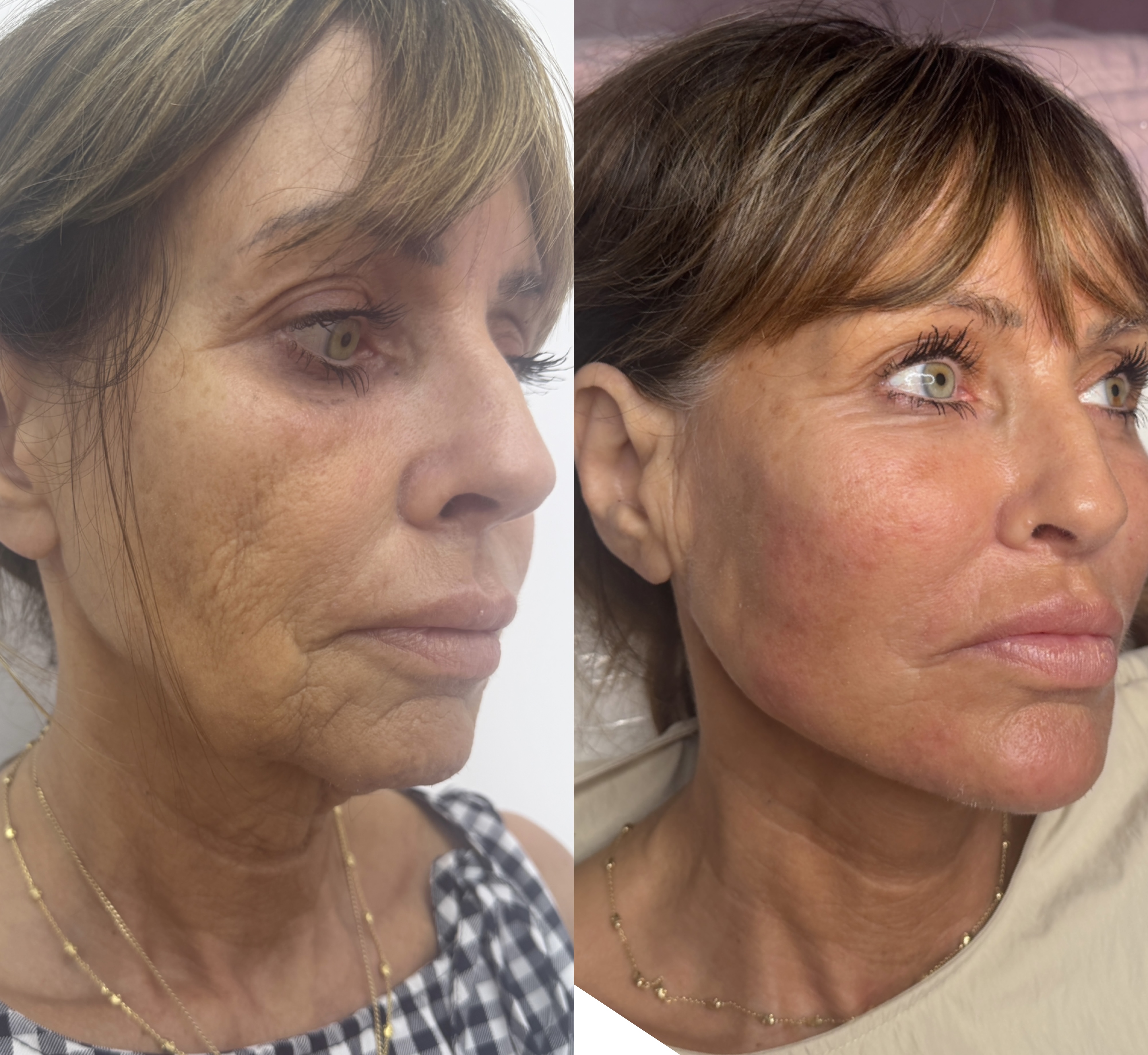 Dermal Filler Injections — before and after results — at ATB Aesthetics | Lip Fillers - Anti Wrinkle Treatments — Maldon