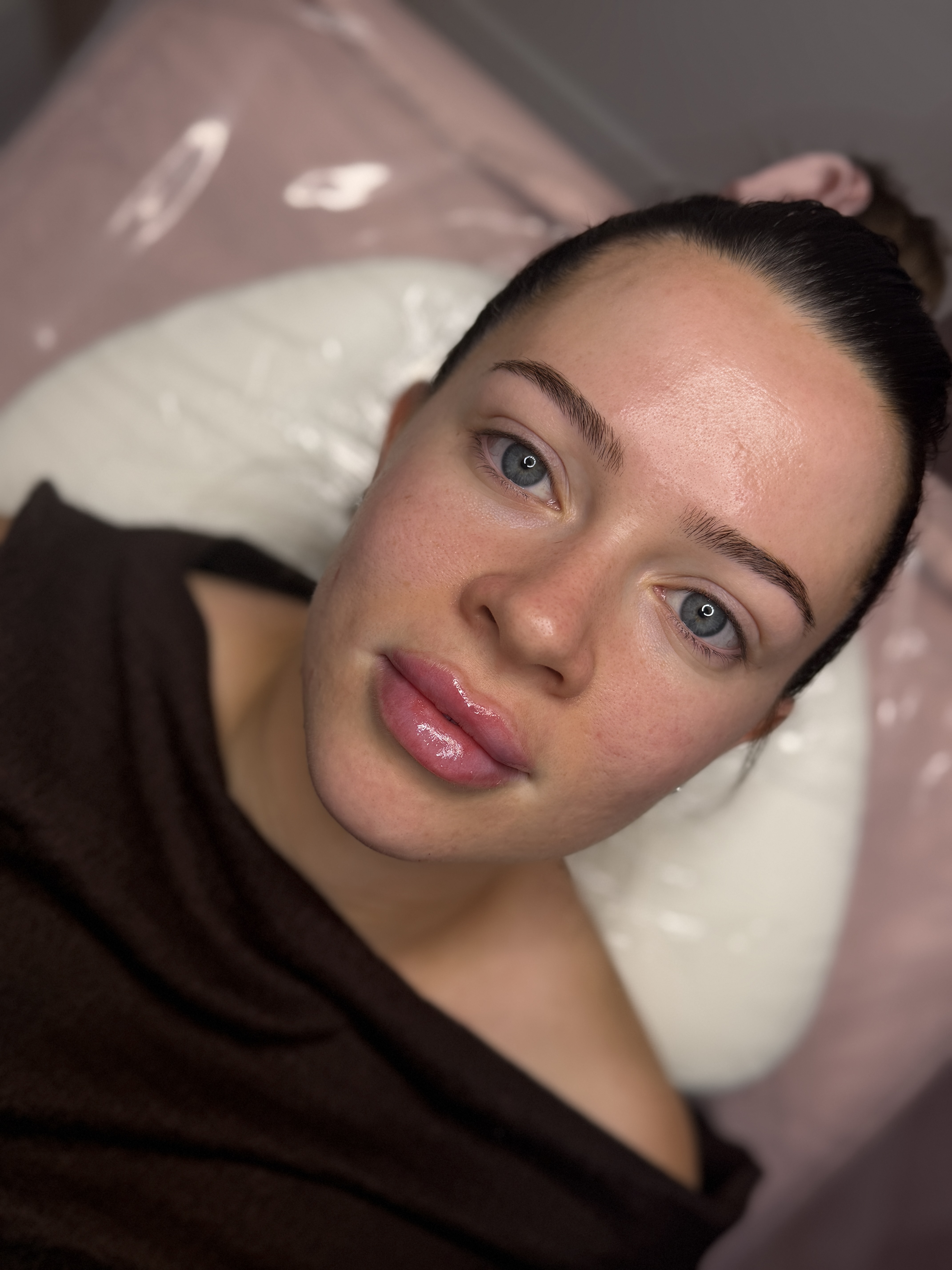 Lip Filler (Augmentation) — treatment results — at ATB Aesthetics | Lip Fillers - Anti Wrinkle Treatments — Maldon