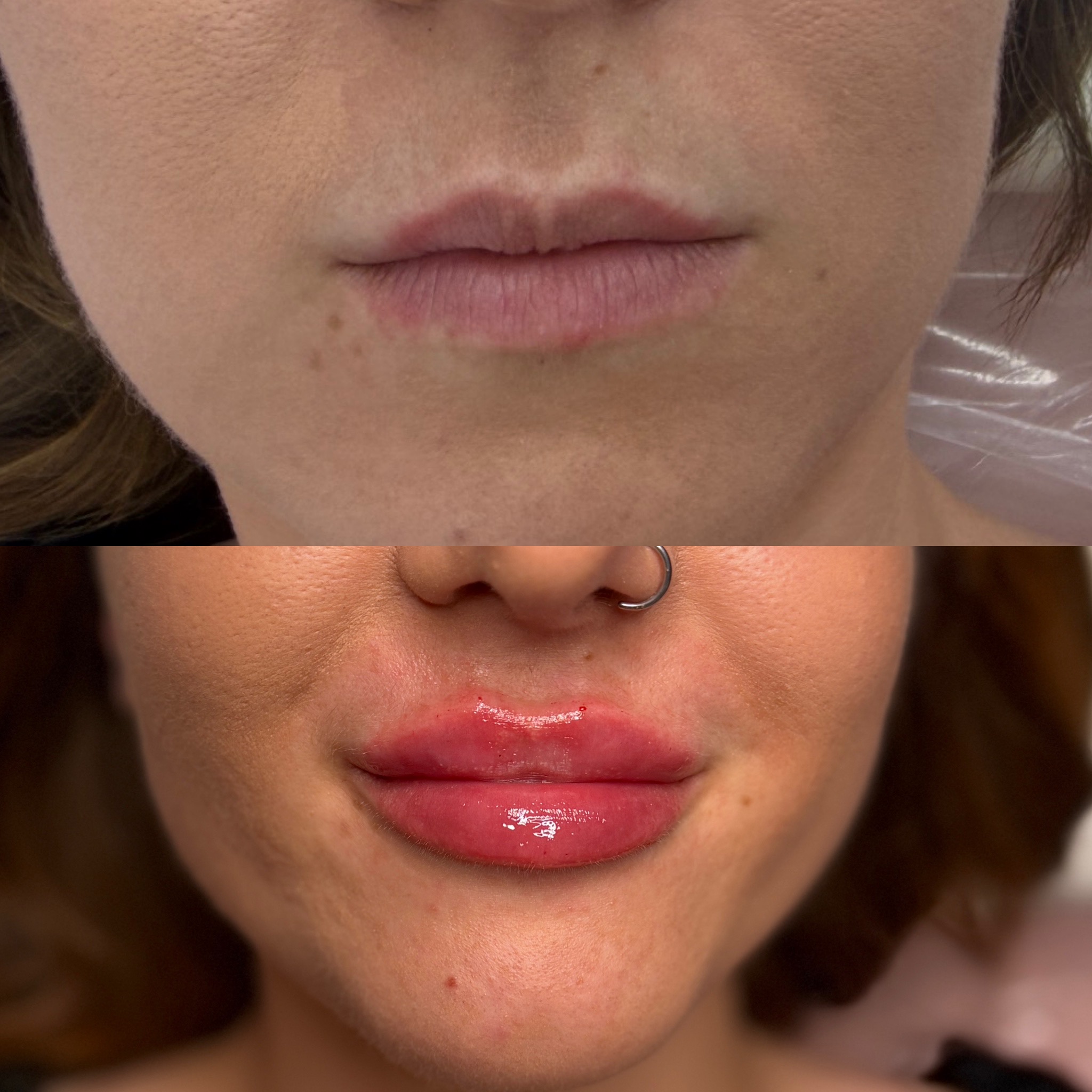 Lip Filler (Augmentation) — before and after results — at ATB Aesthetics | Lip Fillers - Anti Wrinkle Treatments — Maldon
