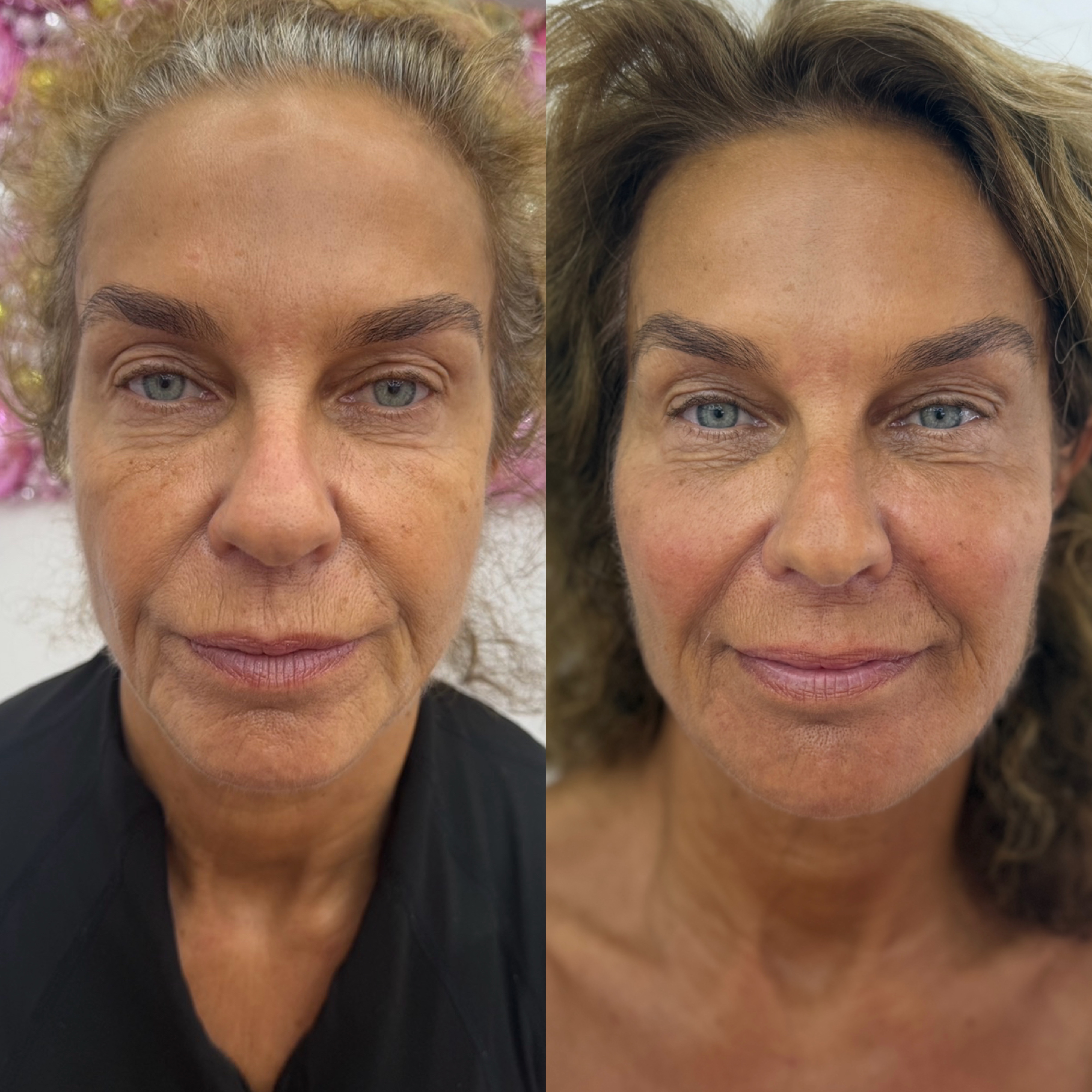 Dermal Filler Injections — before and after results — at ATB Aesthetics | Lip Fillers - Anti Wrinkle Treatments — Maldon