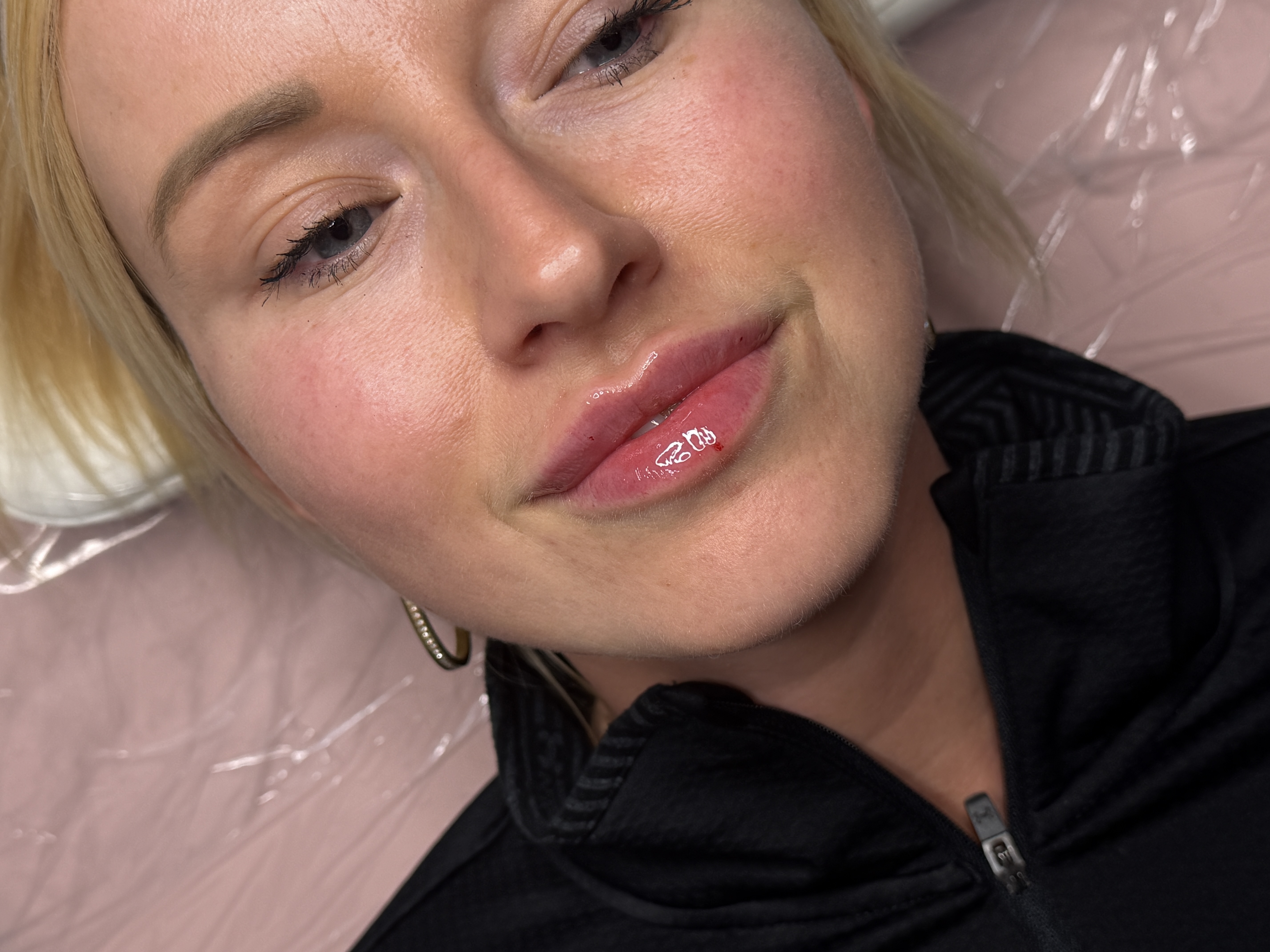 Lip Filler (Augmentation) — treatment results — at ATB Aesthetics | Lip Fillers - Anti Wrinkle Treatments — Maldon