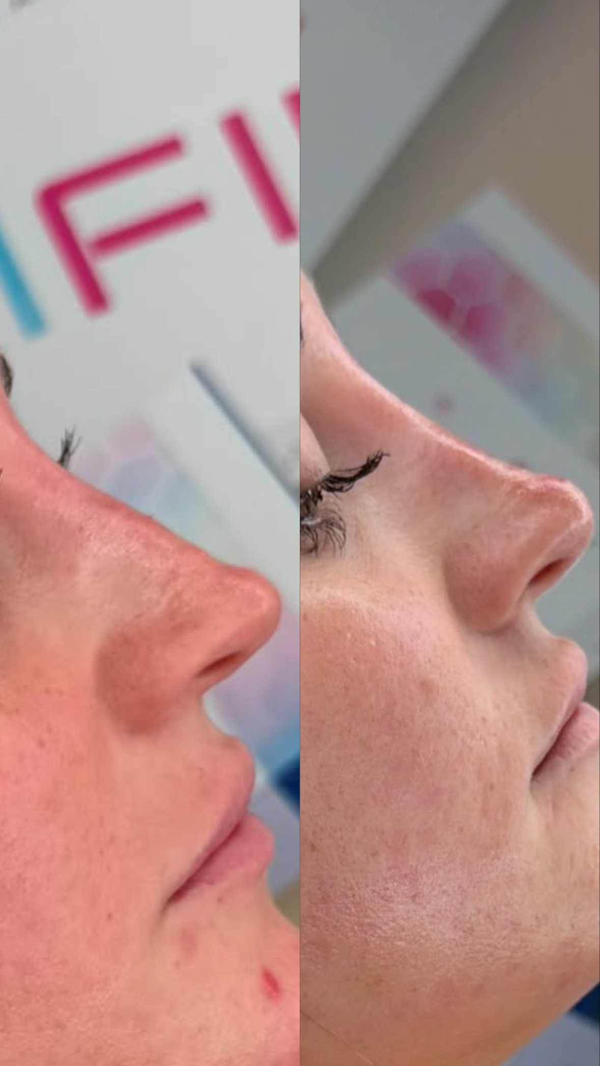 Nose Reshaping (Non-Surgical Rhinoplasty) — before and after results — at Elite Precision Aesthetics — Halesowen
