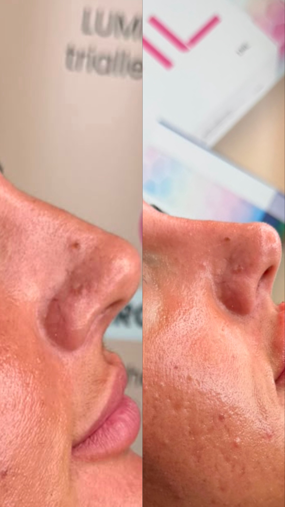 Nose Reshaping (Non-Surgical Rhinoplasty) — before and after results — at Elite Precision Aesthetics — Halesowen