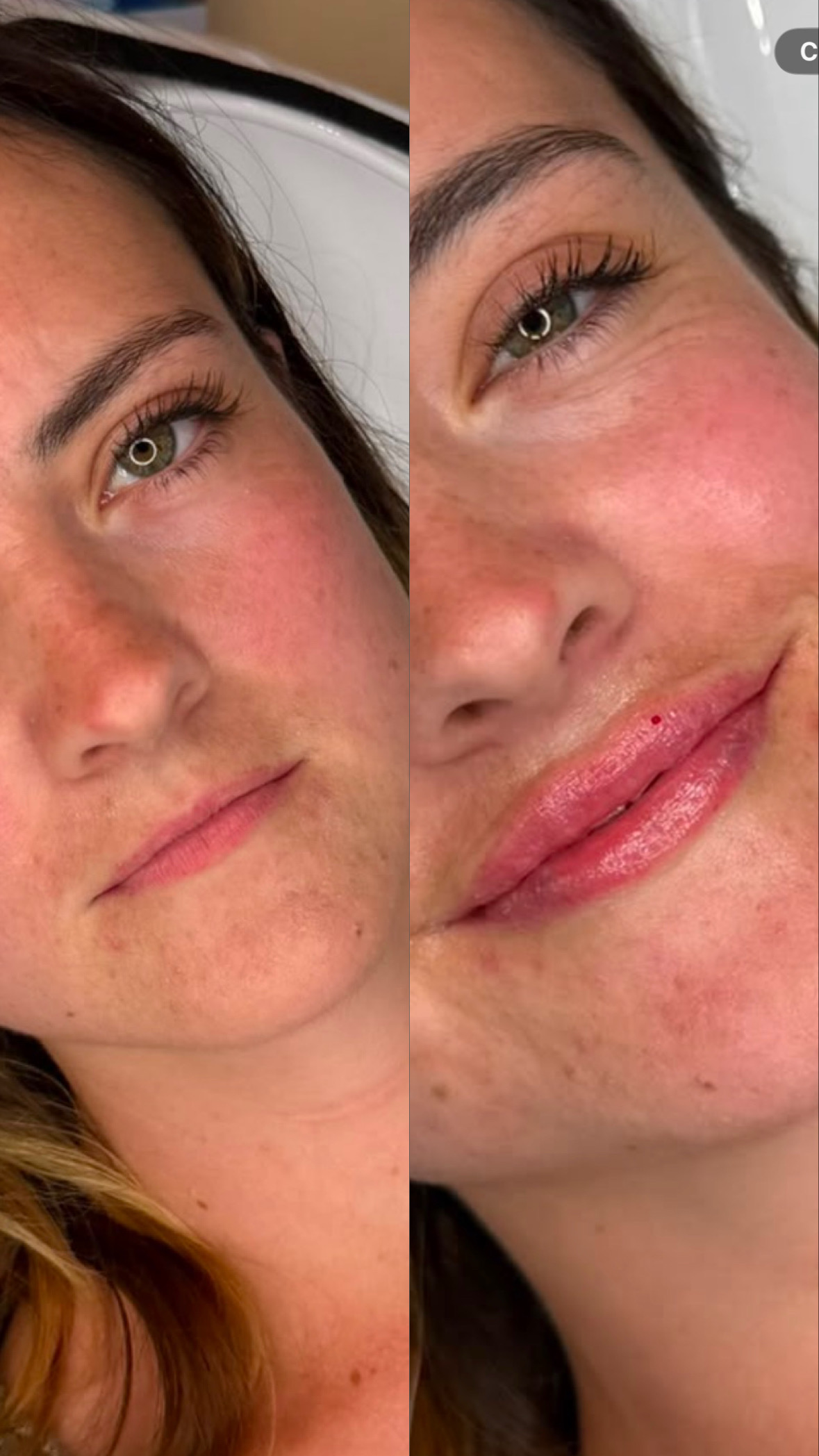Lip Filler (Augmentation) — before and after results — at Elite Precision Aesthetics — Halesowen