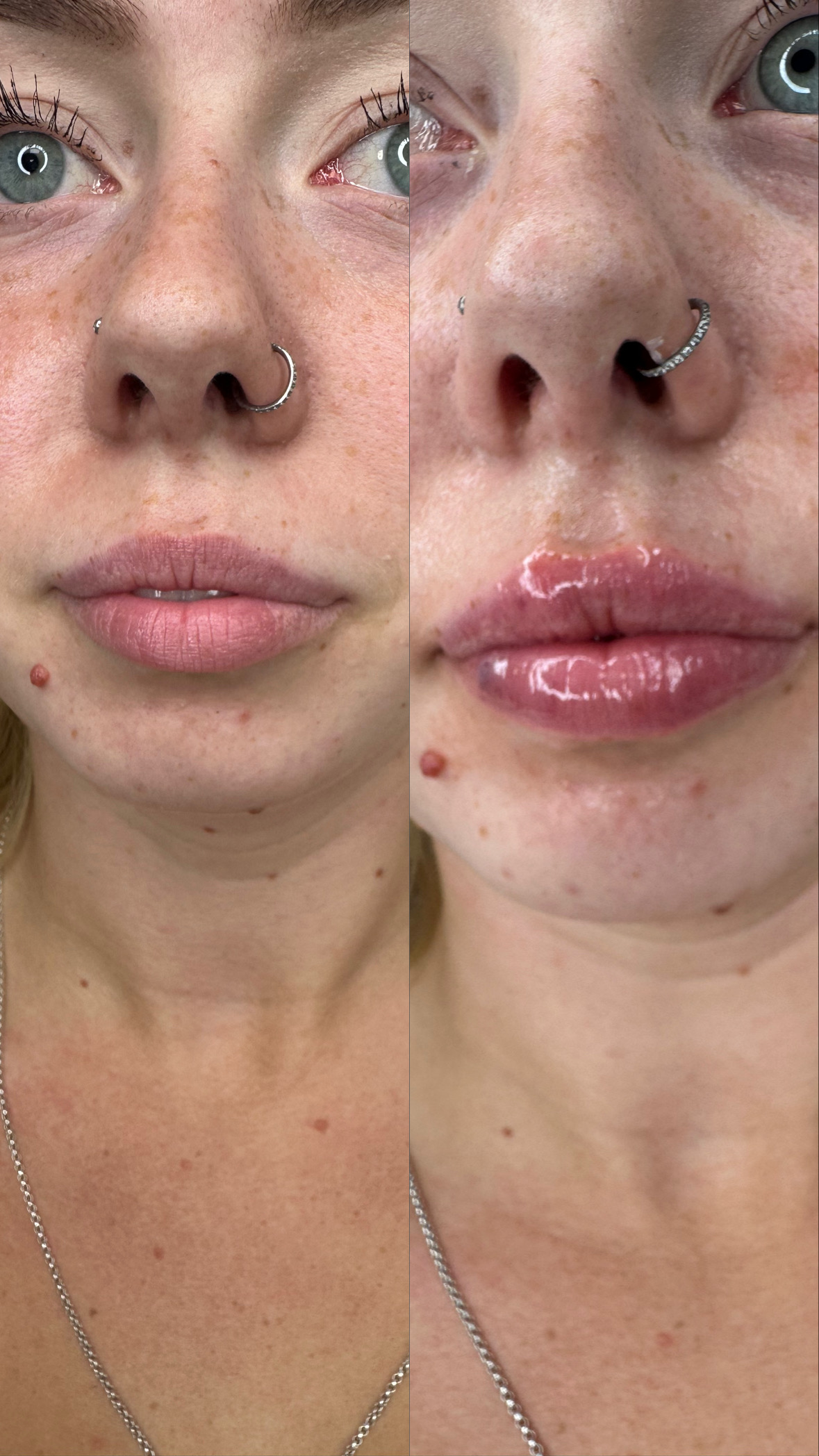 Lip Filler (Augmentation) — before and after results — at Elite Precision Aesthetics — Halesowen