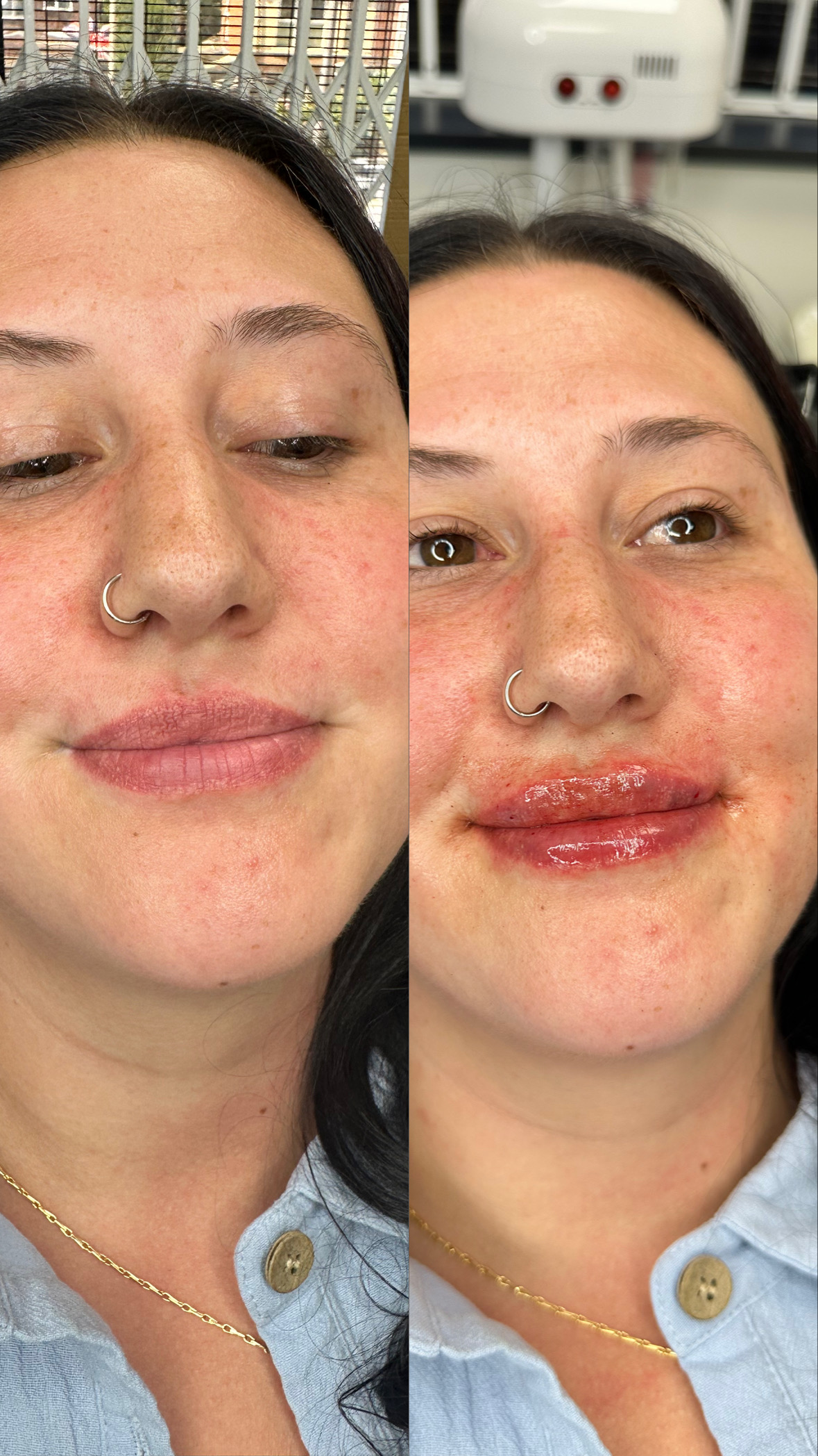Lip Filler (Augmentation) — before and after results — at Elite Precision Aesthetics — Halesowen