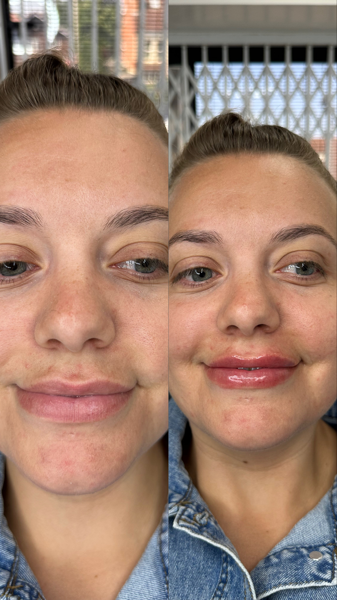 Lip Filler (Augmentation) — before and after results — at Elite Precision Aesthetics — Halesowen