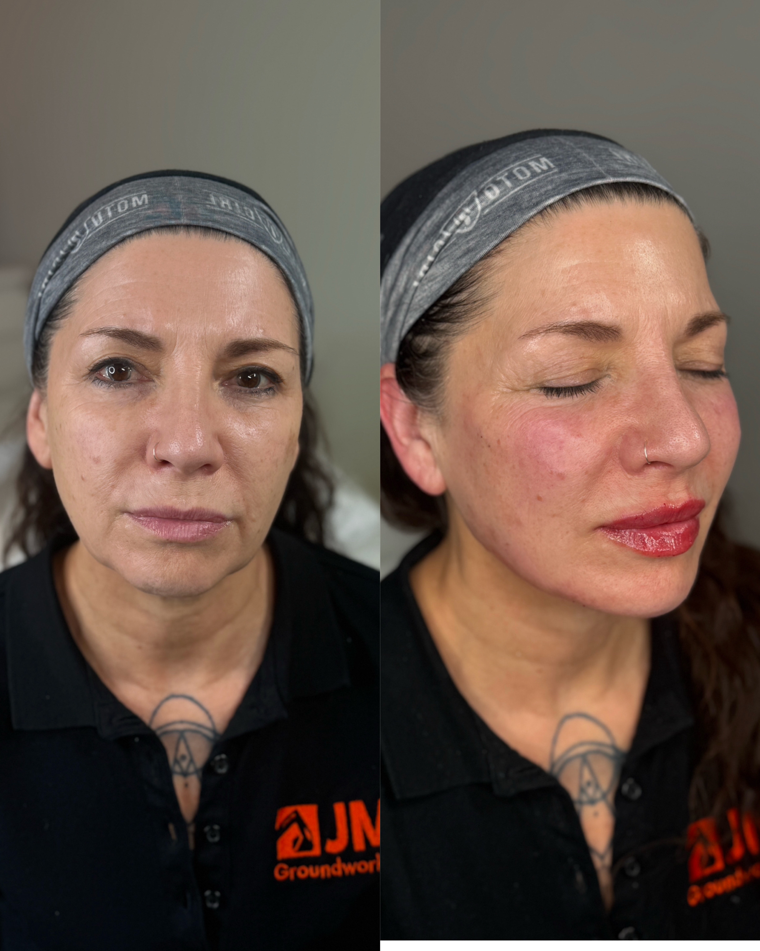 Dermal Filler Injections — before and after results — at faces by LL  — torquay