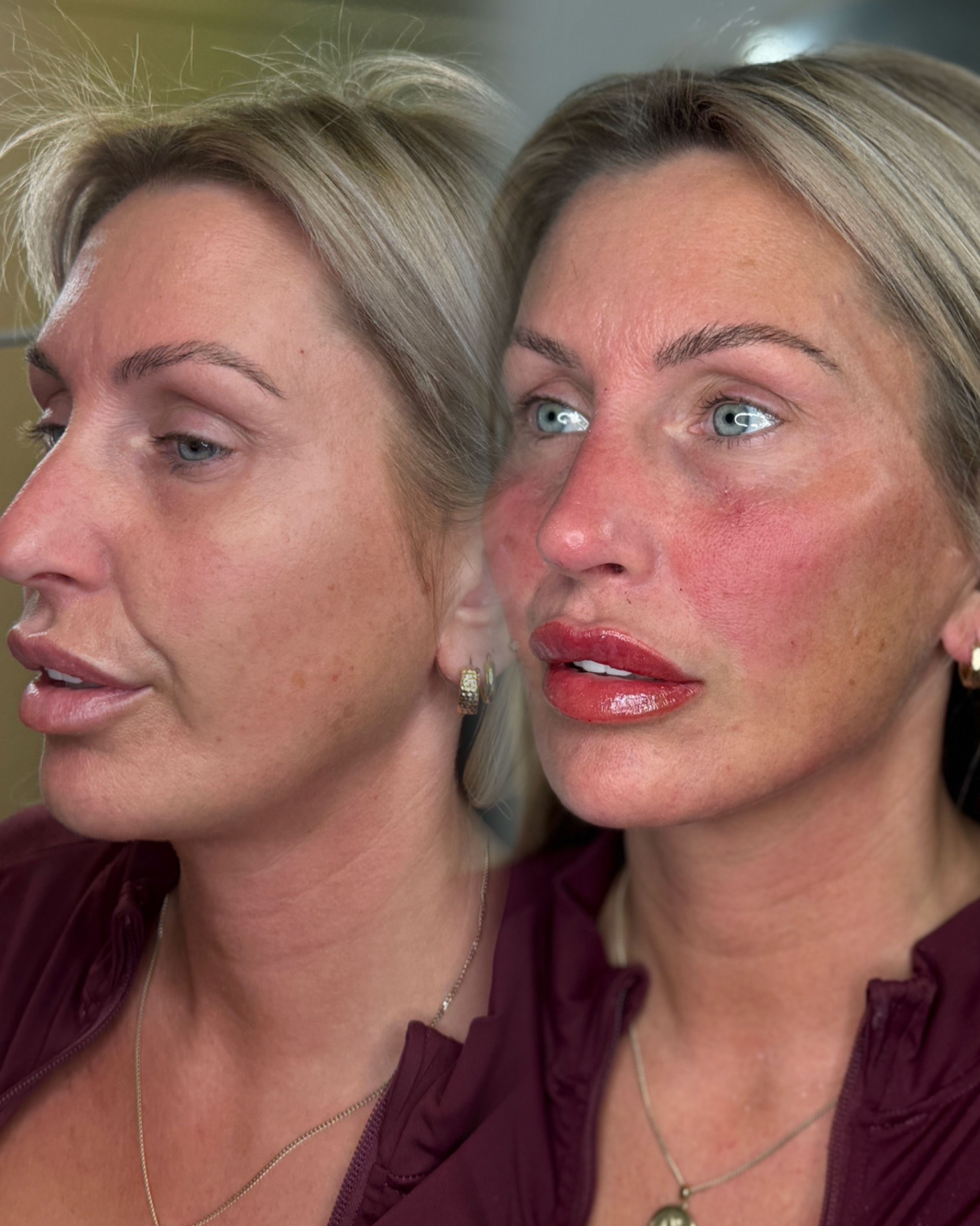 Dermal Filler Injections — before and after results — at faces by LL  — torquay