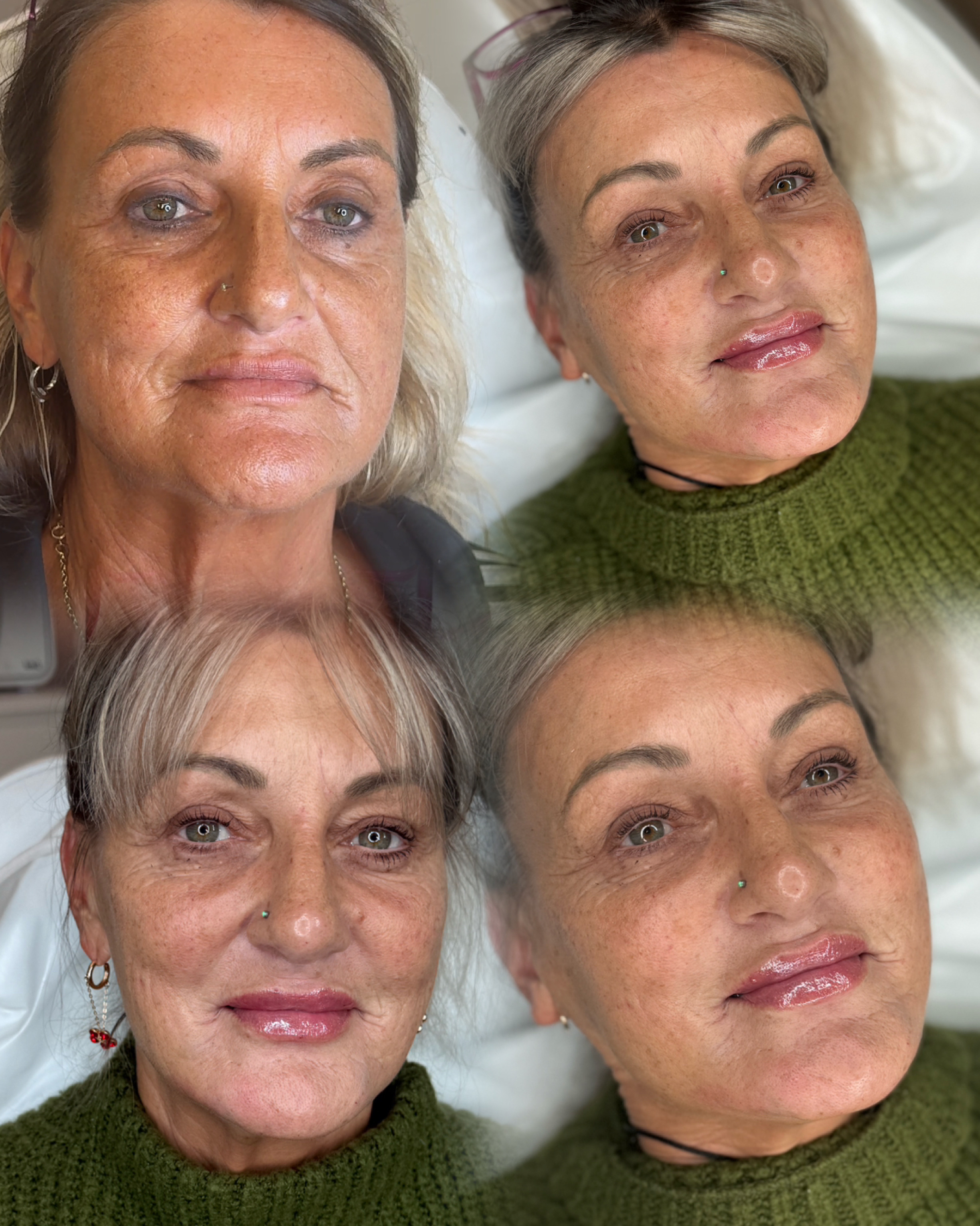 Dermal Filler Injections — before and after results — at faces by LL  — torquay