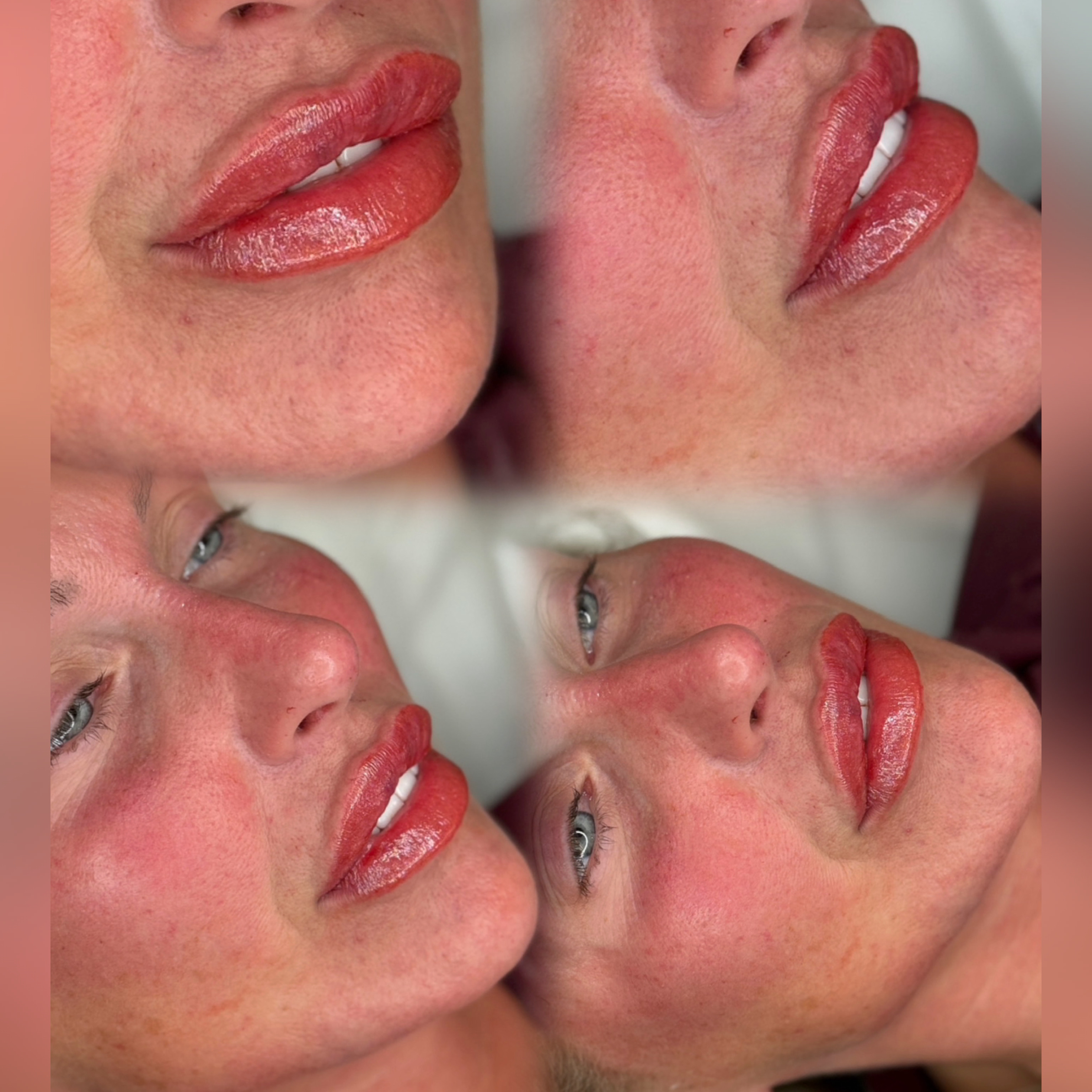 Lip Filler (Augmentation) — treatment results — at faces by LL  — torquay