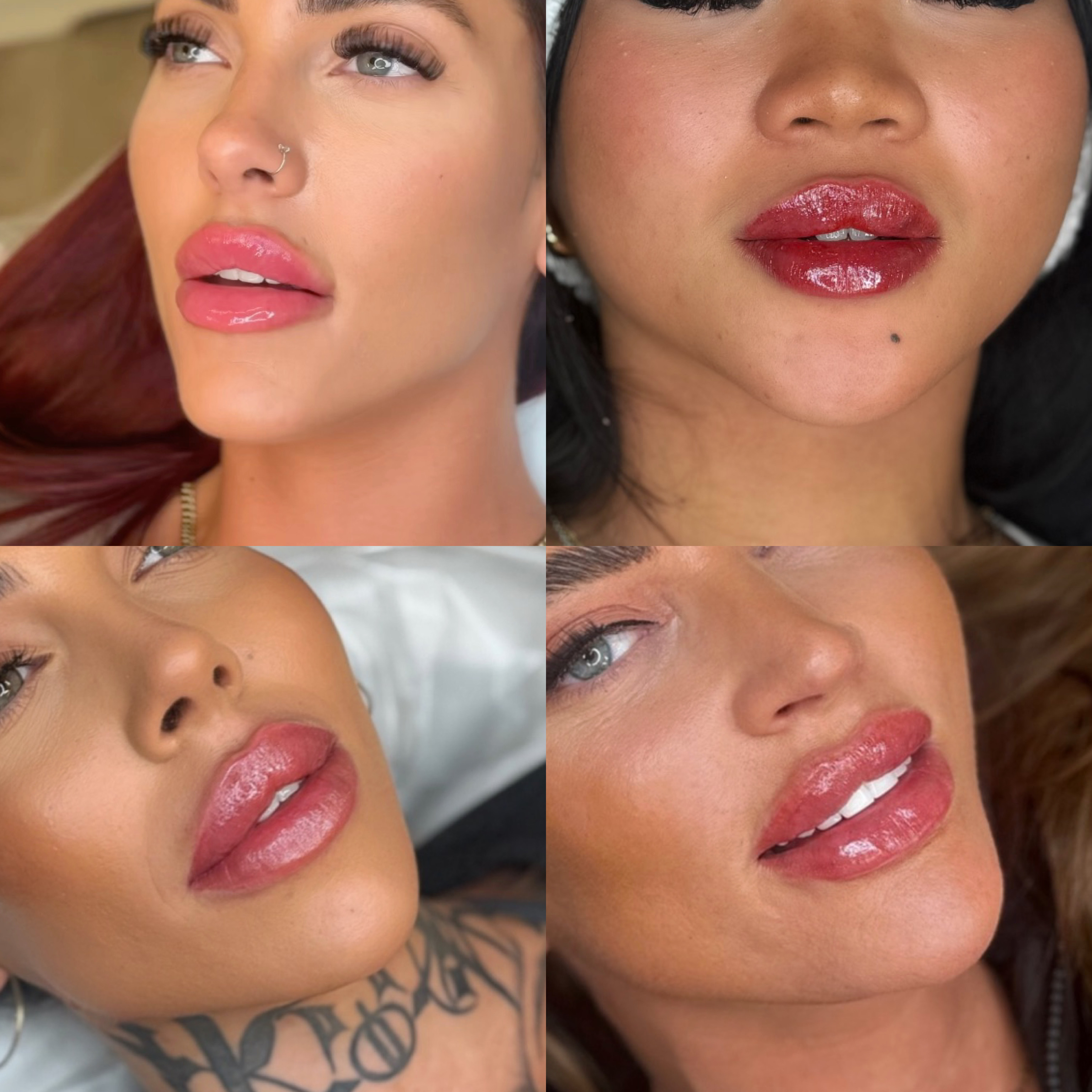Lip Filler (Augmentation) — treatment results — at faces by LL  — torquay