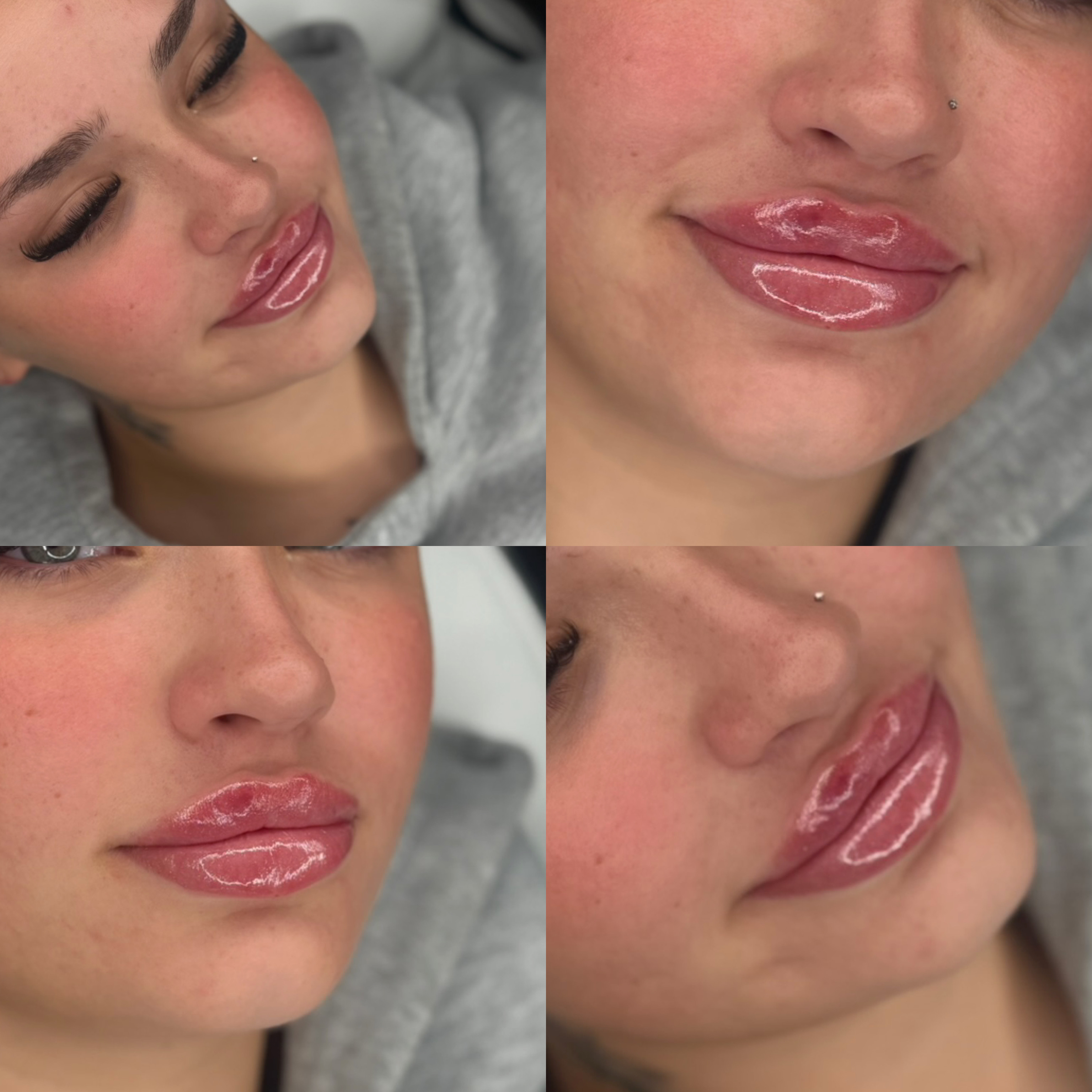 Lip Filler (Augmentation) — treatment results — at faces by LL  — torquay
