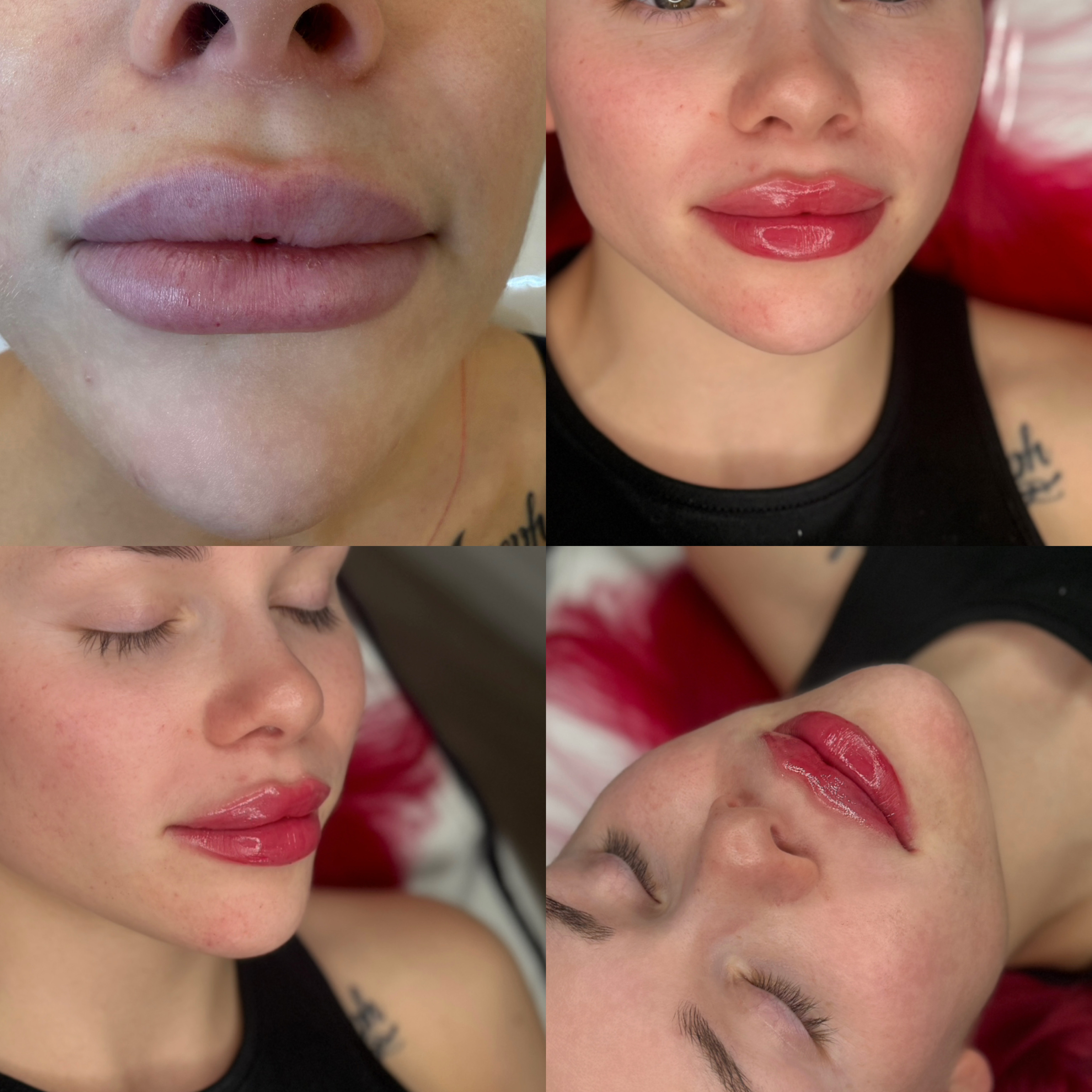 Lip Filler (Augmentation) — before and after results — at faces by LL  — torquay