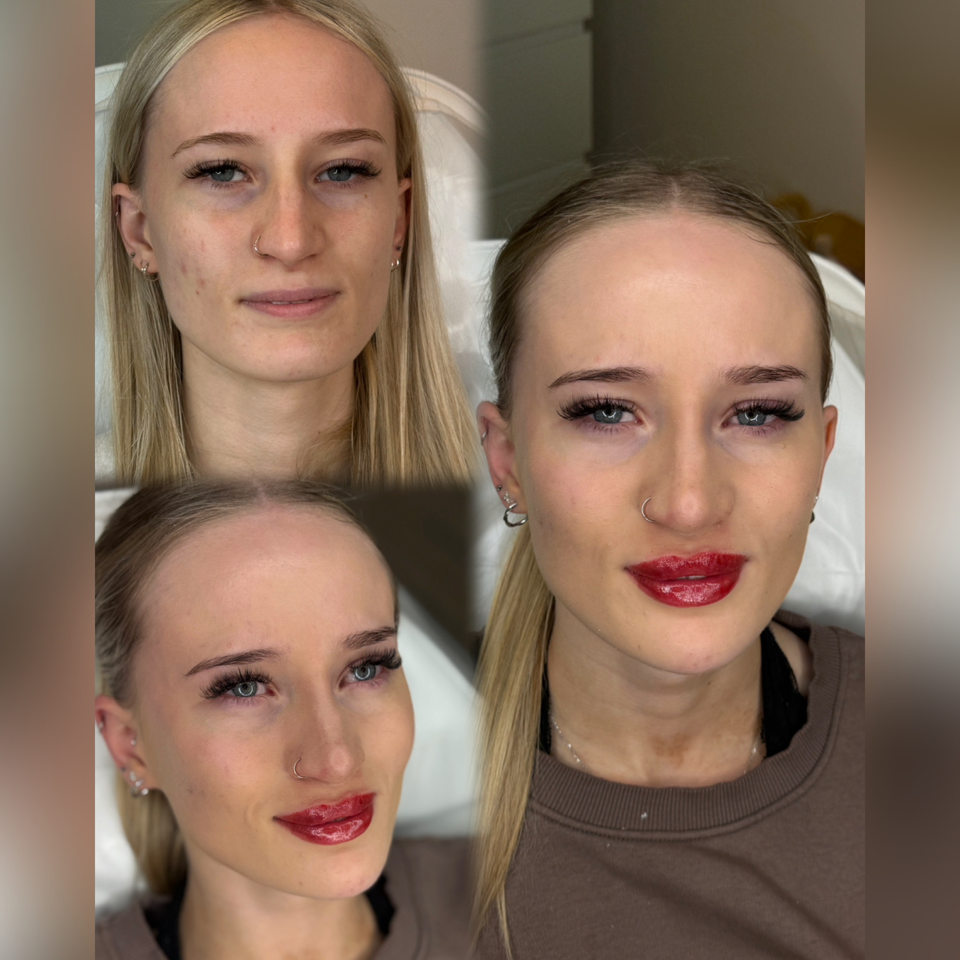 Dermal Filler Injections — before and after results — at faces by LL  — torquay