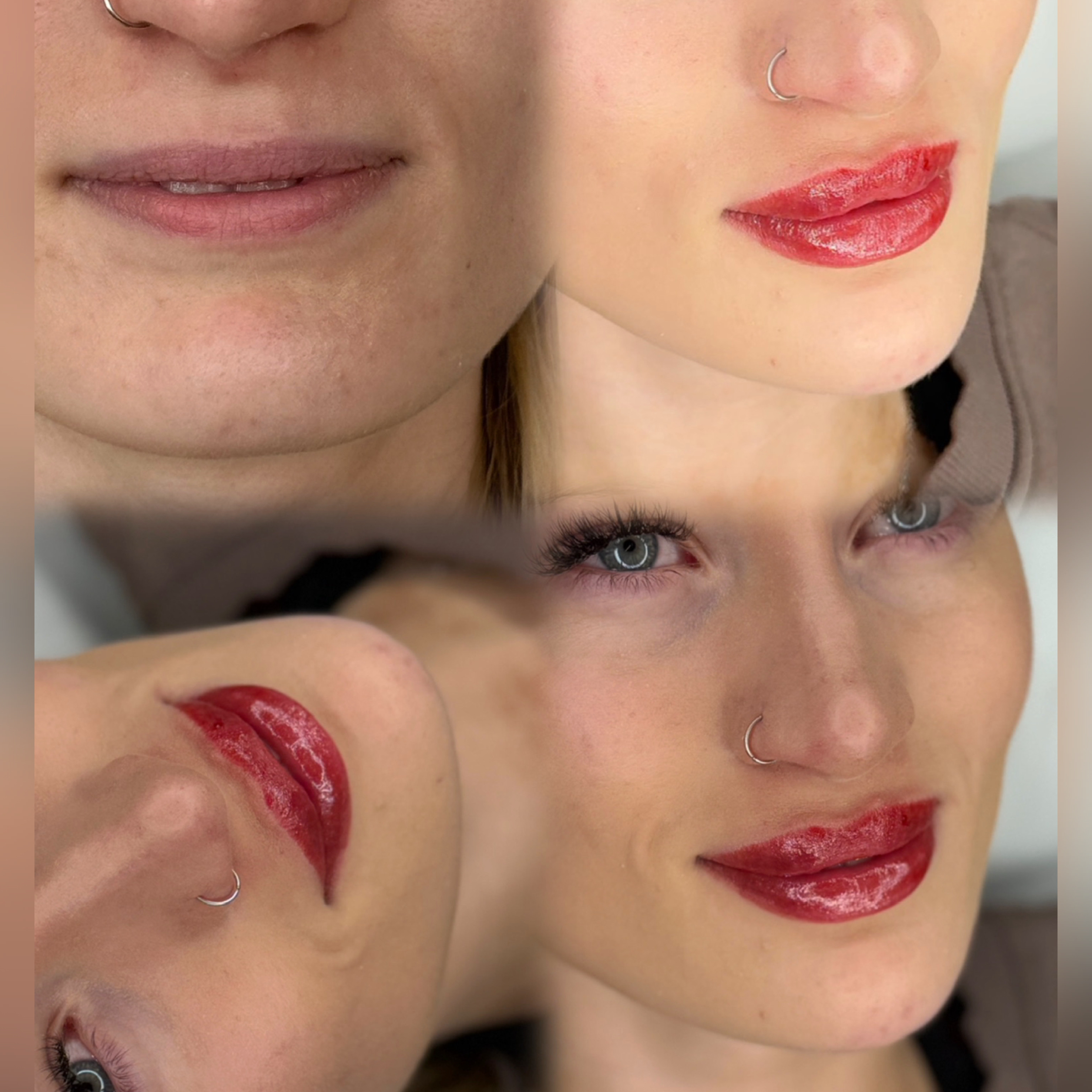 Lip Filler (Augmentation) — before and after results — at faces by LL  — torquay
