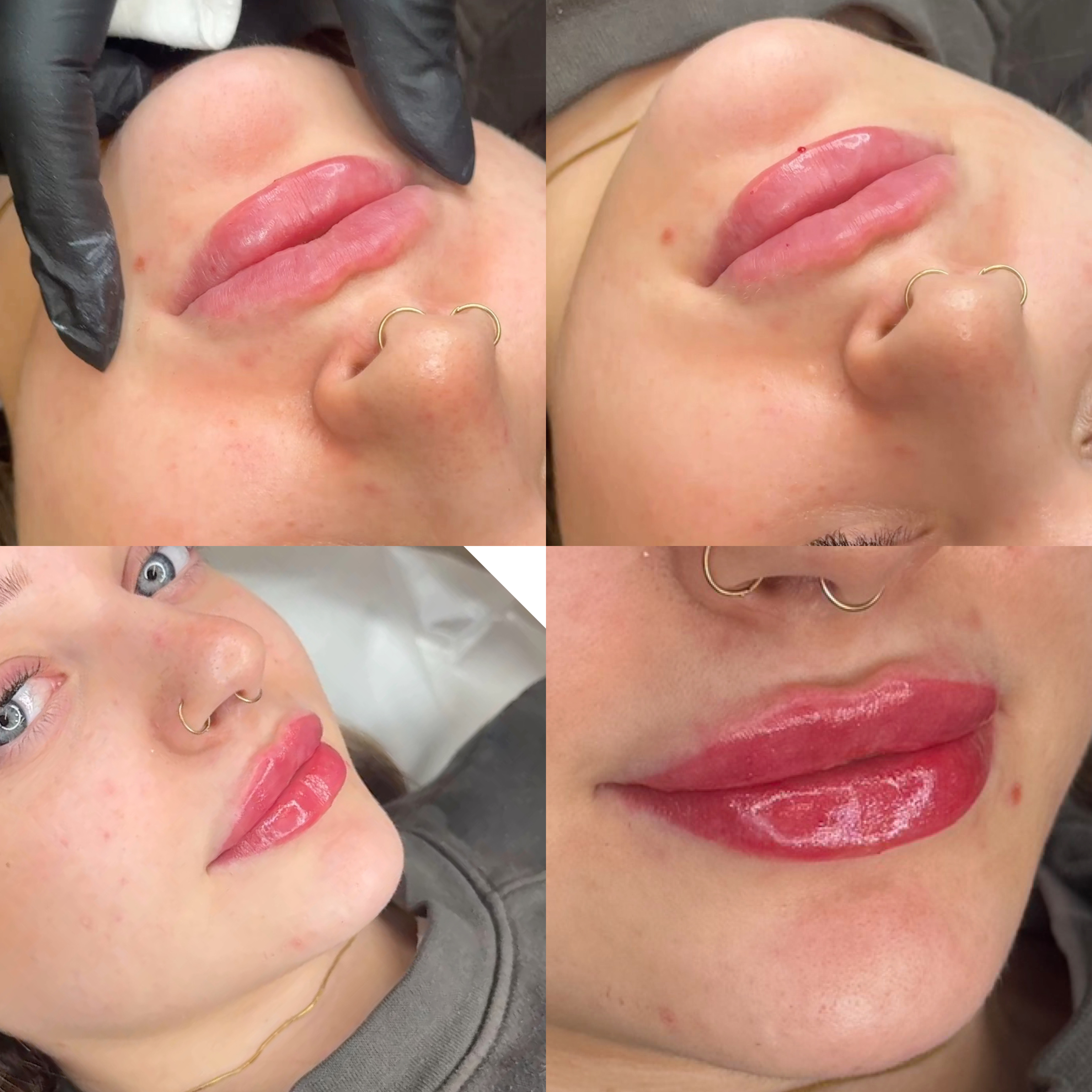 Lip Filler (Augmentation) — treatment results — at faces by LL  — torquay