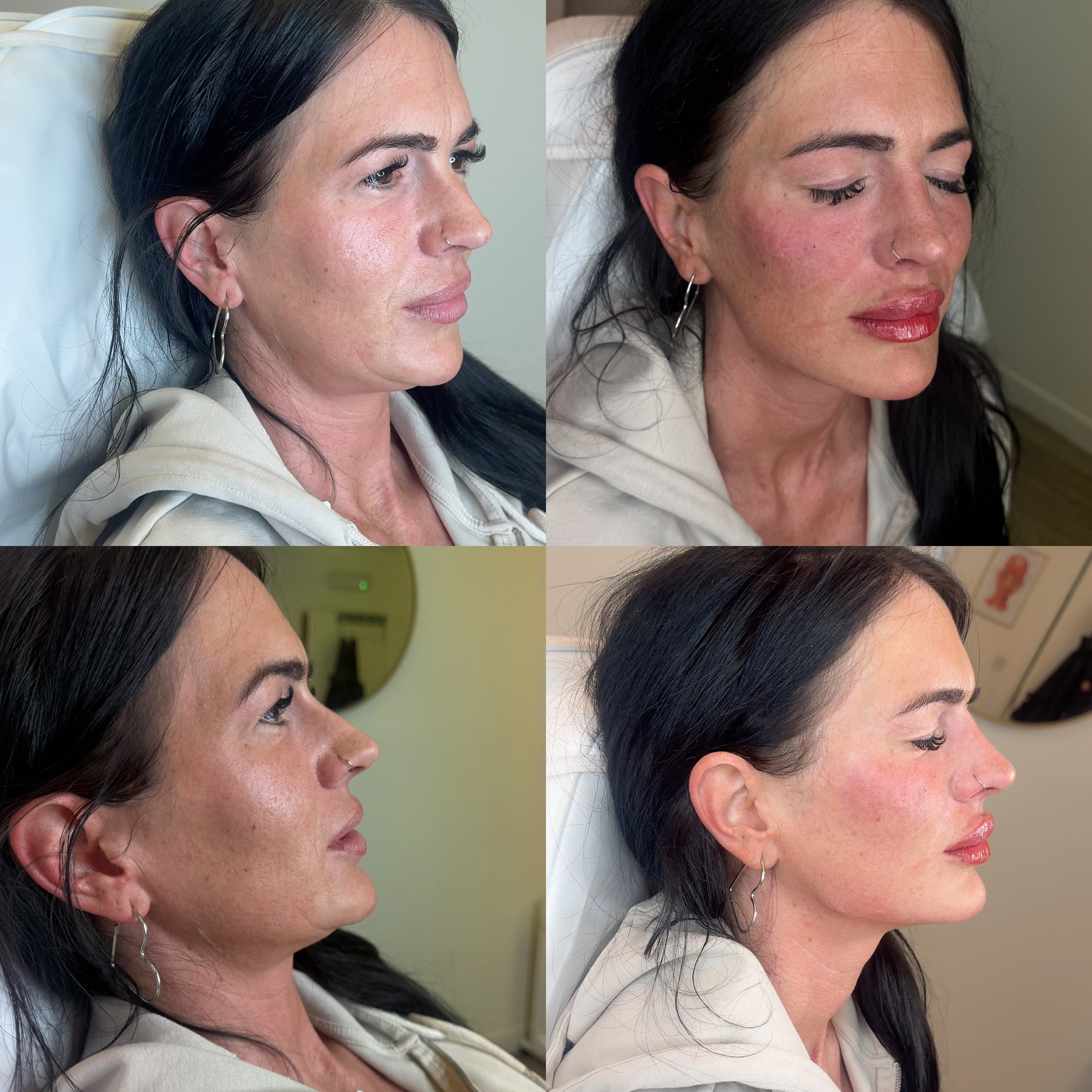 Dermal Filler Injections — before and after results — at faces by LL  — torquay