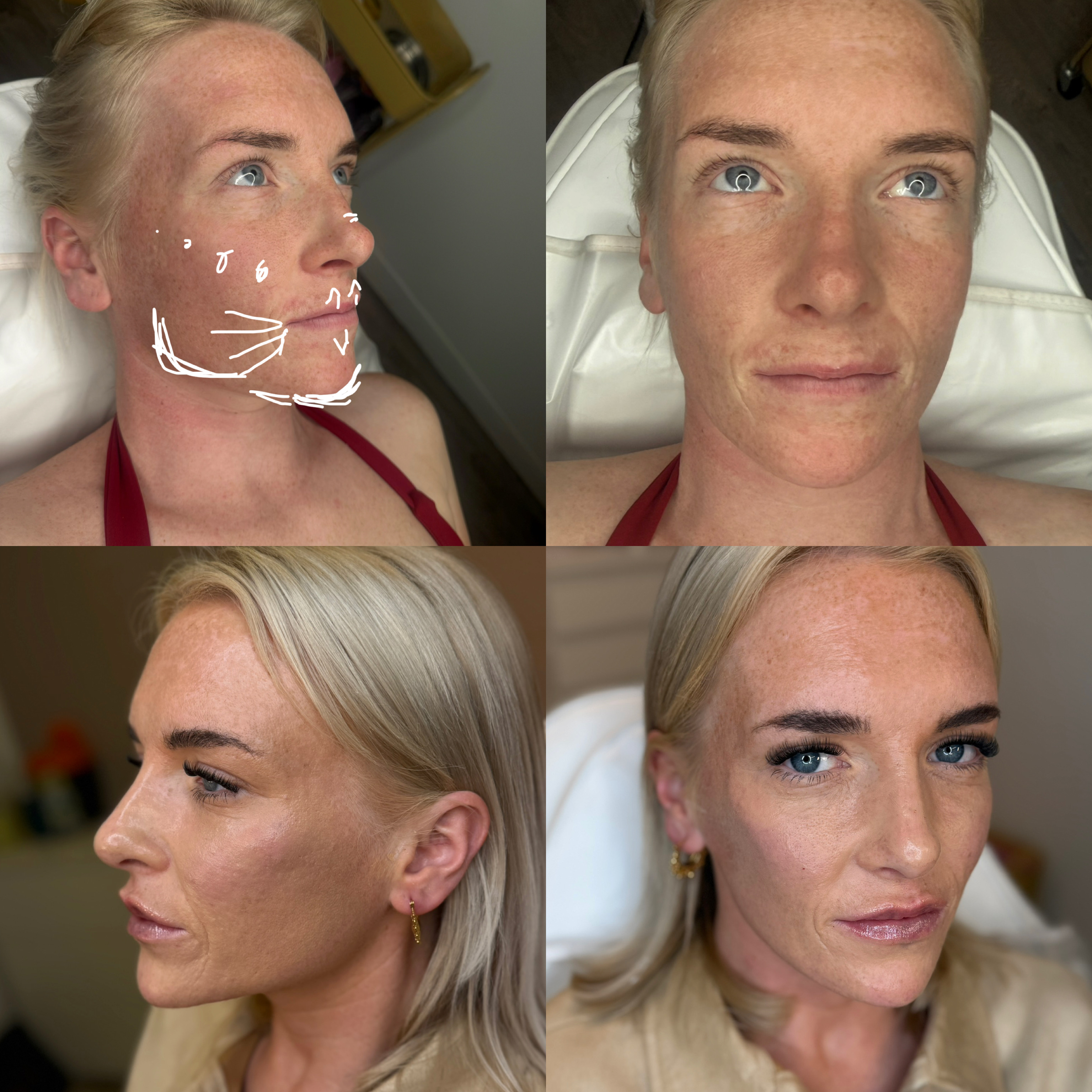 Dermal Filler Injections — before and after results — at faces by LL  — torquay
