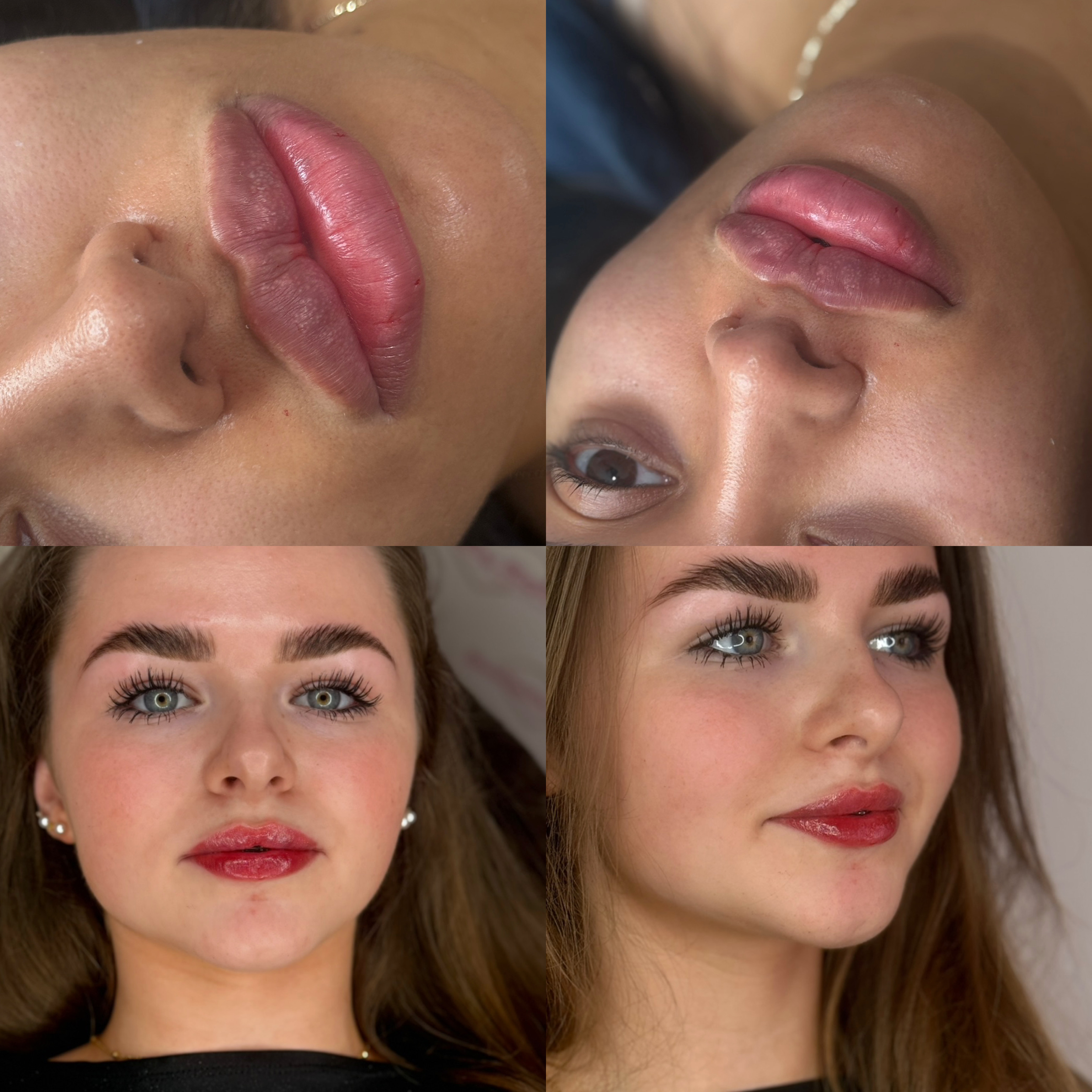 Lip Filler (Augmentation) — before and after results — at faces by LL  — torquay
