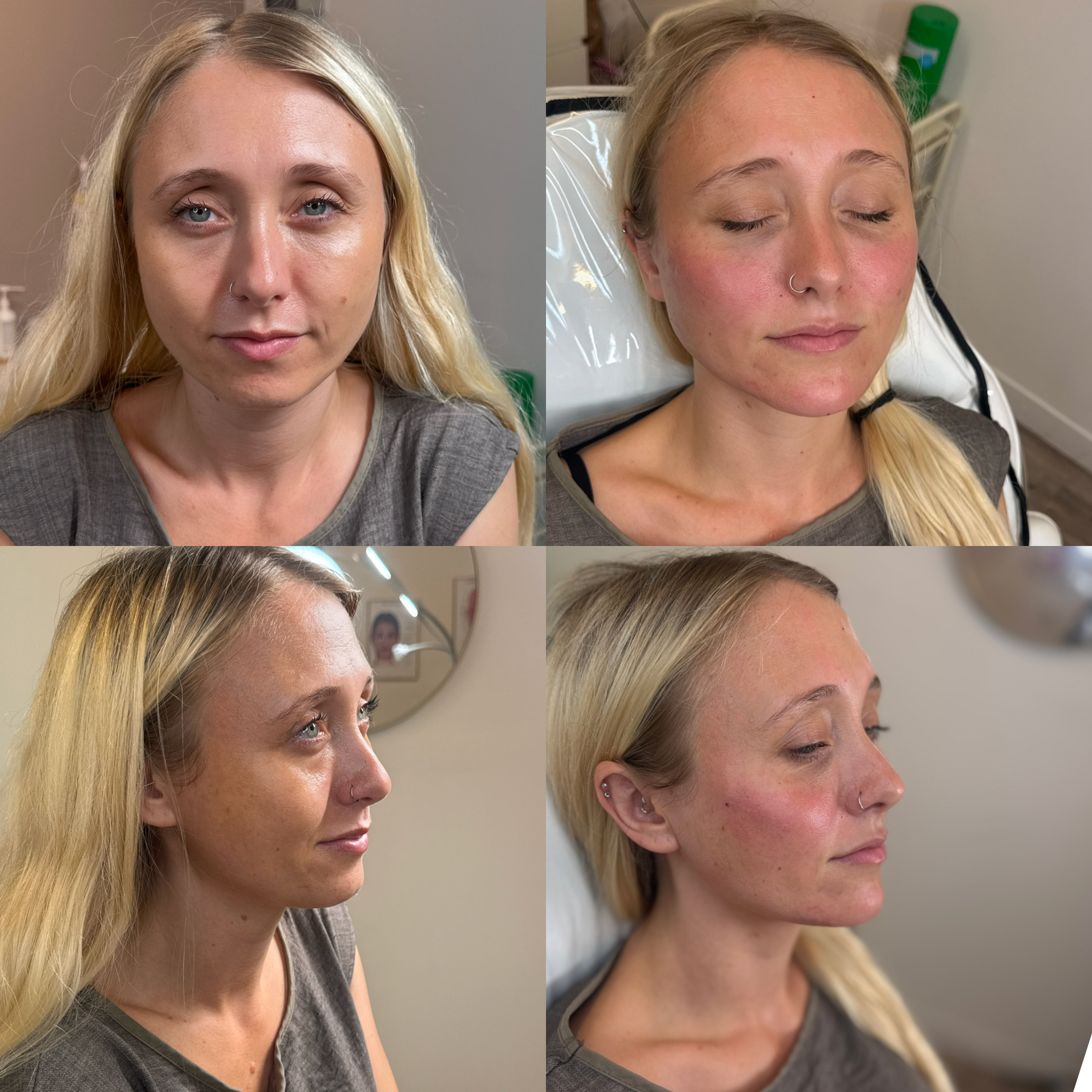 Dermal Filler Injections — before and after results — at faces by LL  — torquay