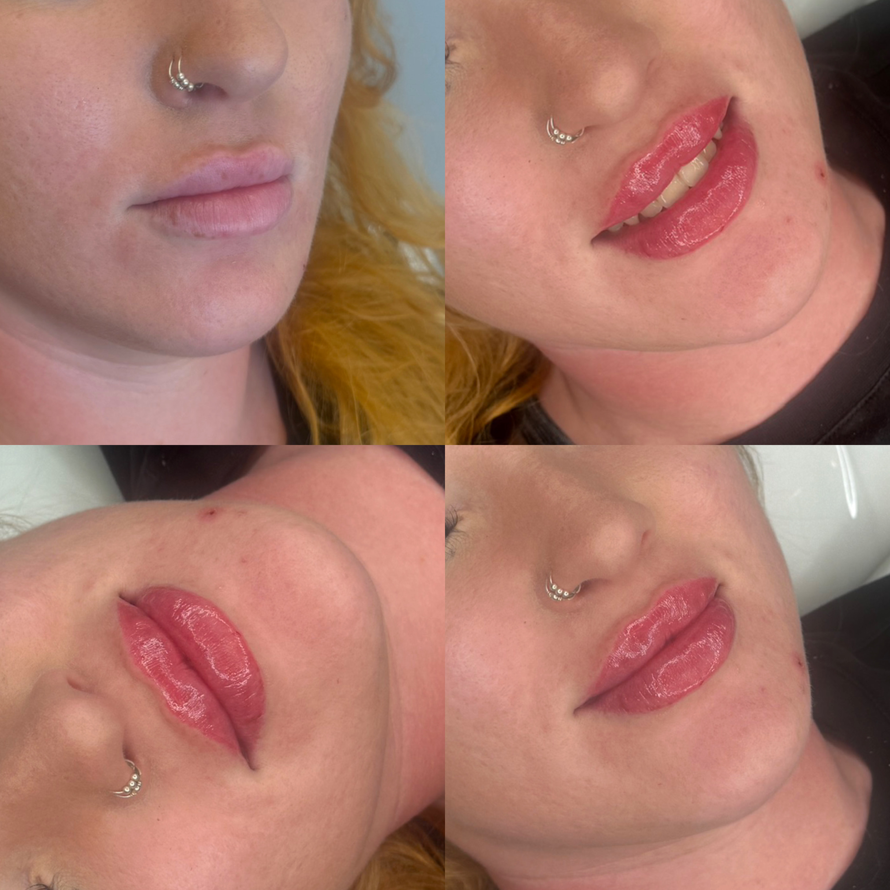 Lip Filler (Augmentation) — before and after results — at faces by LL  — torquay