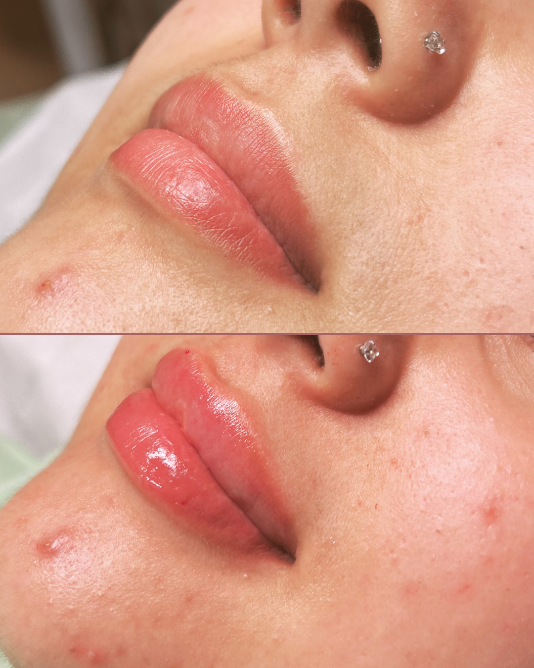 Lip Filler (Augmentation) — before and after results — at Coastal Beauty and Aesthetics Blakeney — Holt