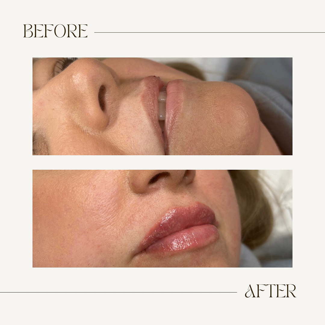 Lip Filler (Augmentation) — before and after results — at Coastal Beauty and Aesthetics Blakeney — Holt