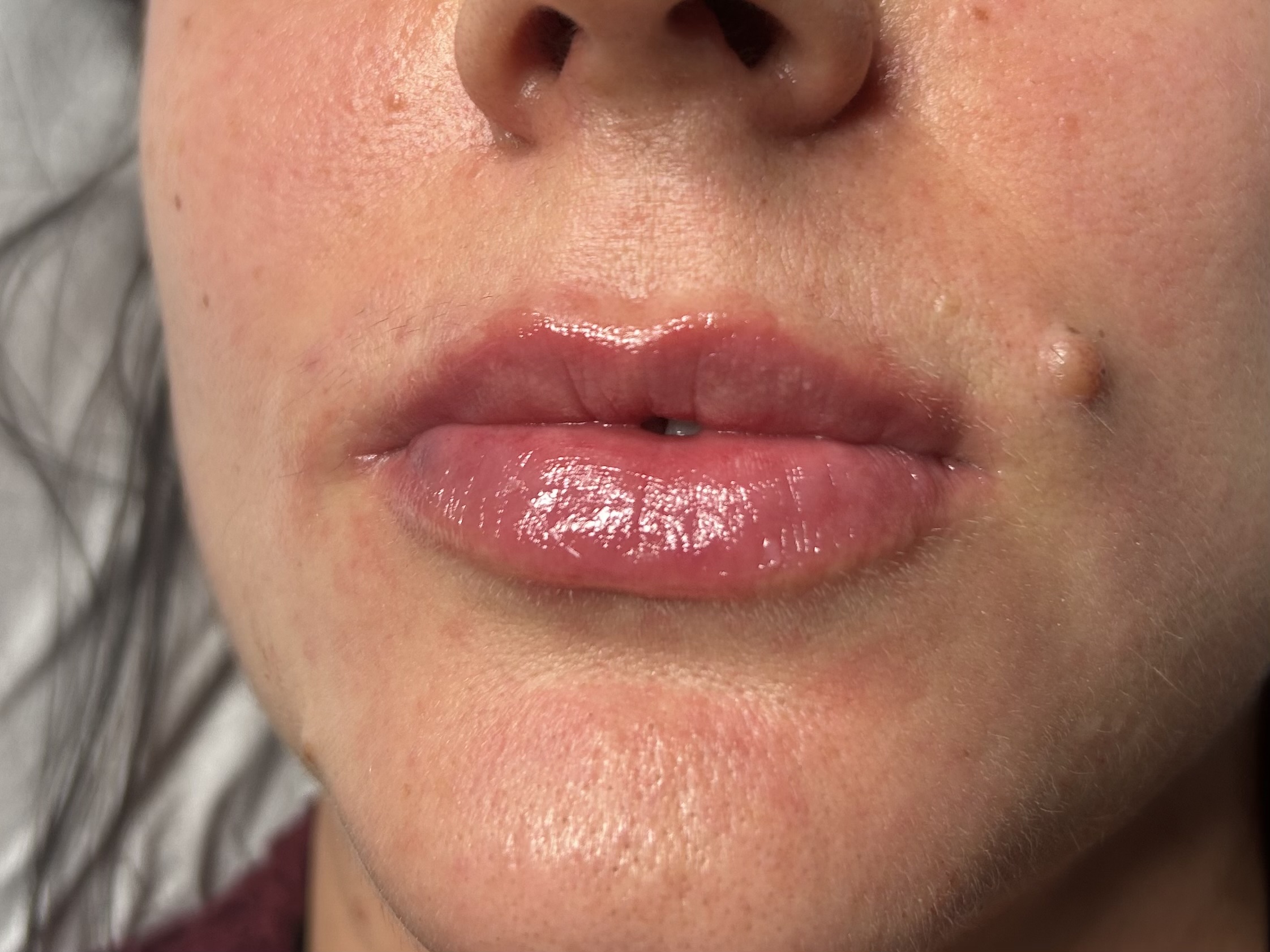 Lip Filler (Augmentation) — treatment results — at Coastal Beauty and Aesthetics Blakeney — Holt